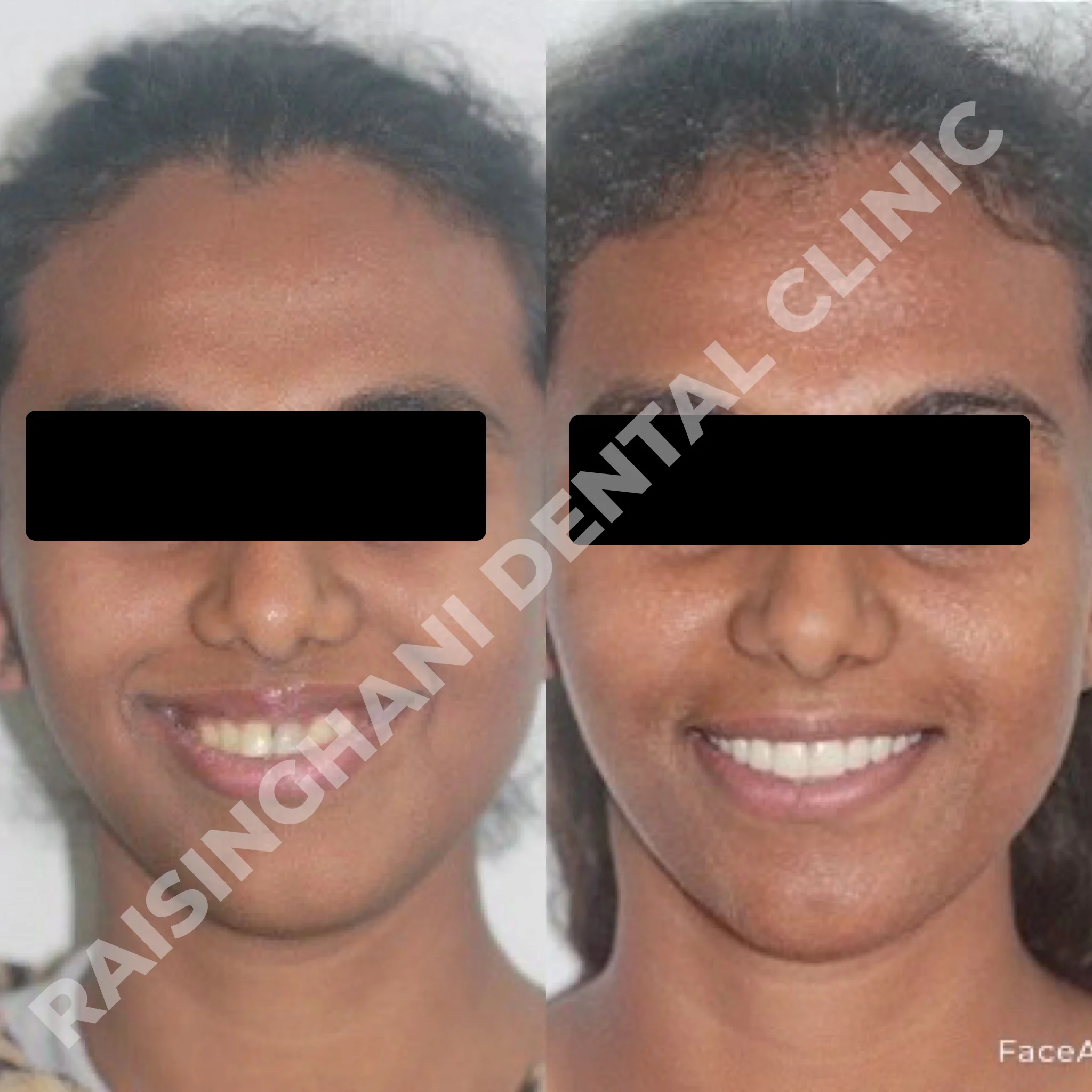 Braces & Aligners