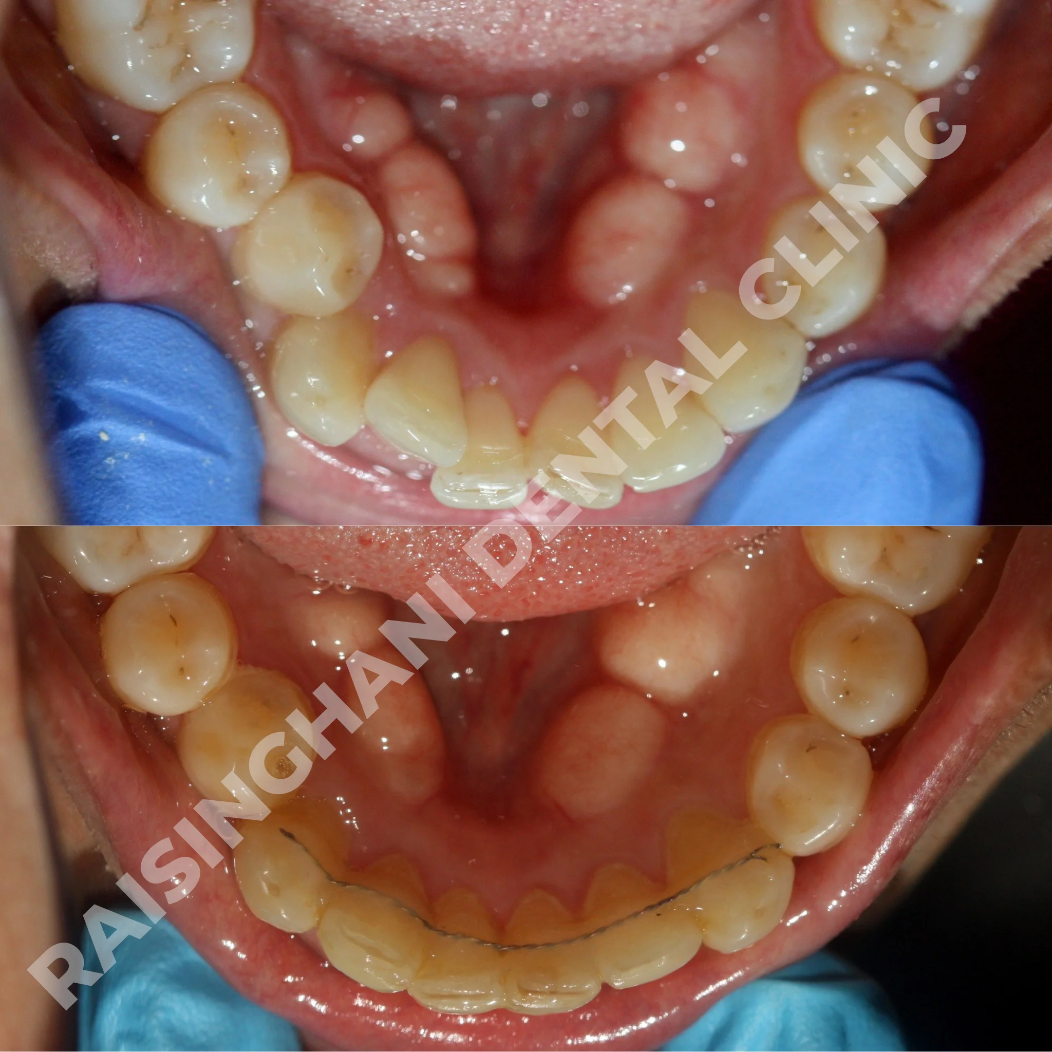 Braces & Aligners