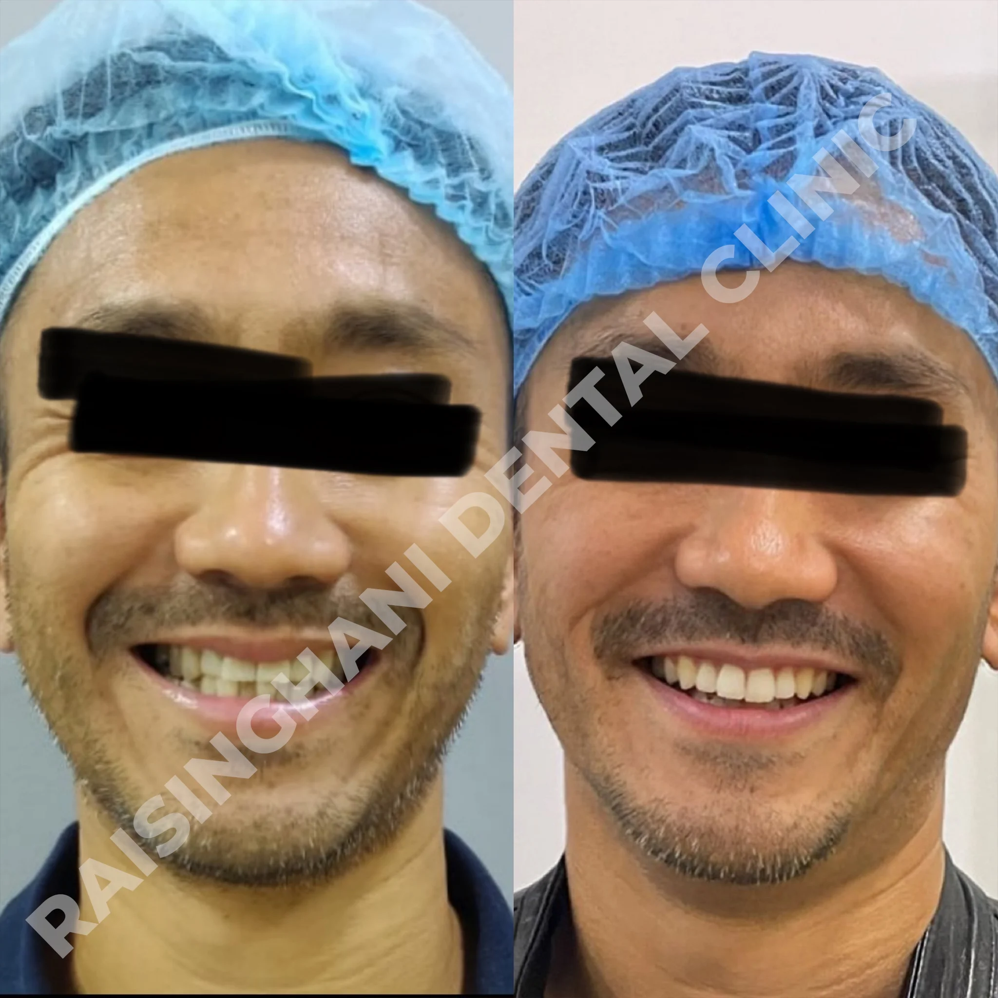 Braces & Aligners