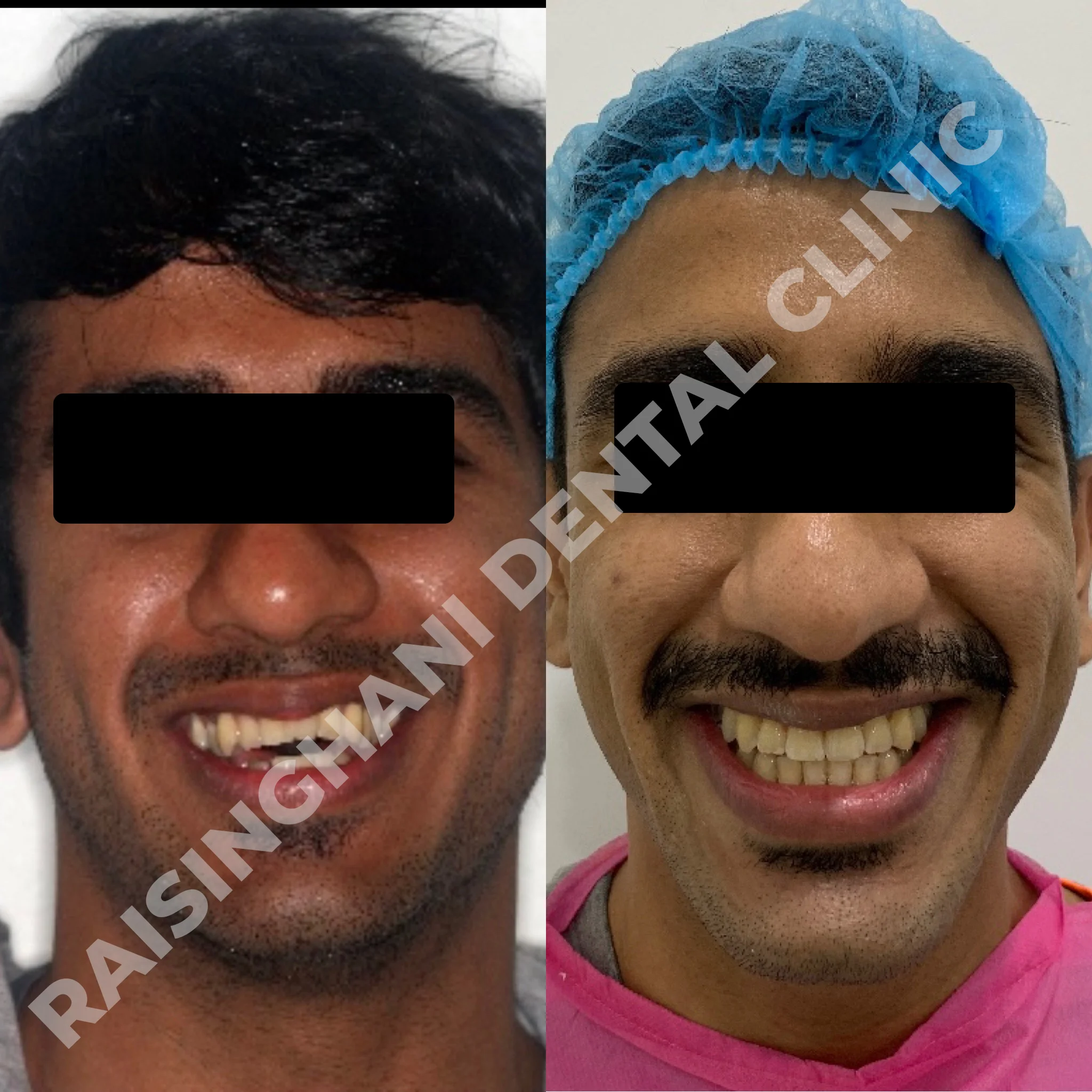 Braces & Aligners