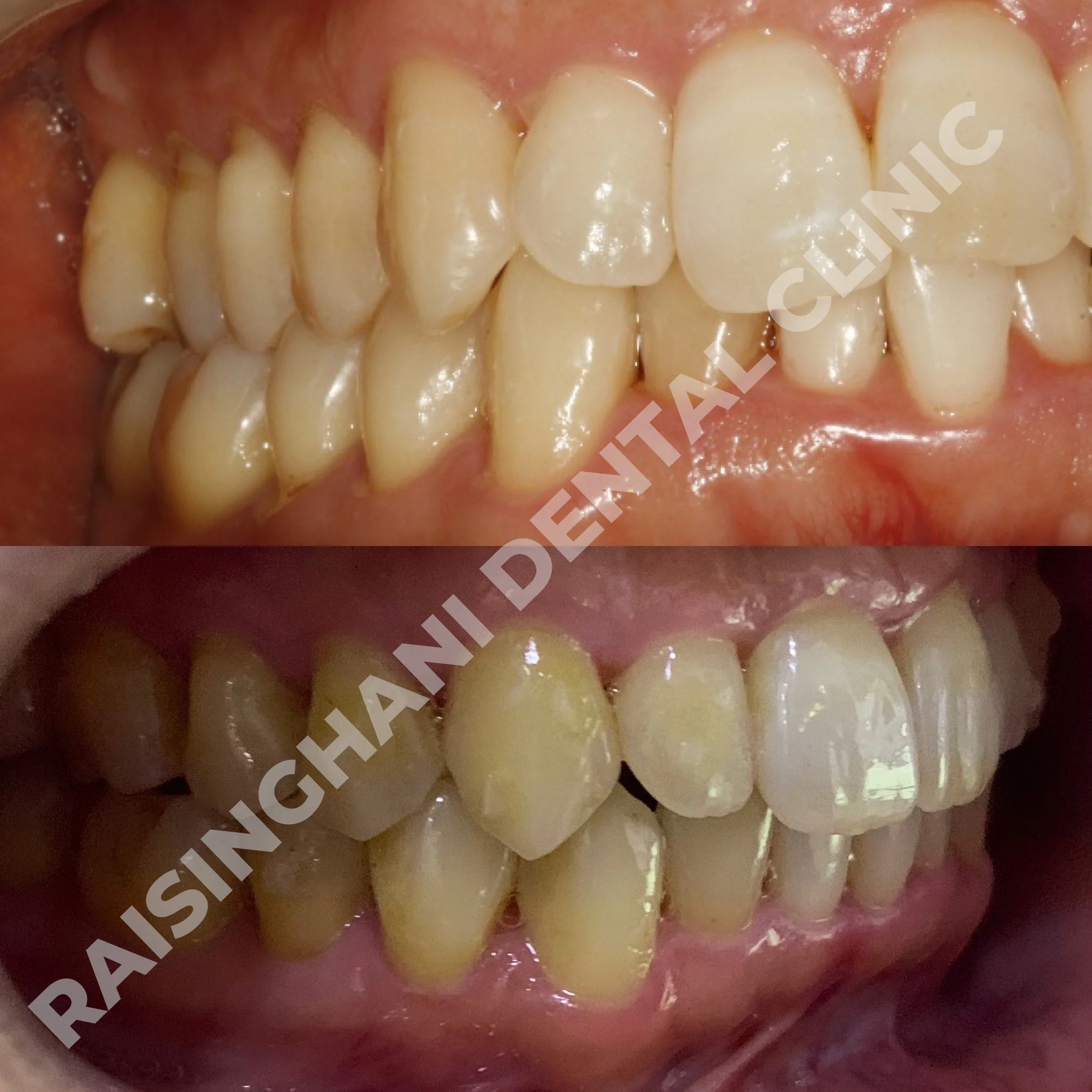Braces & Aligners