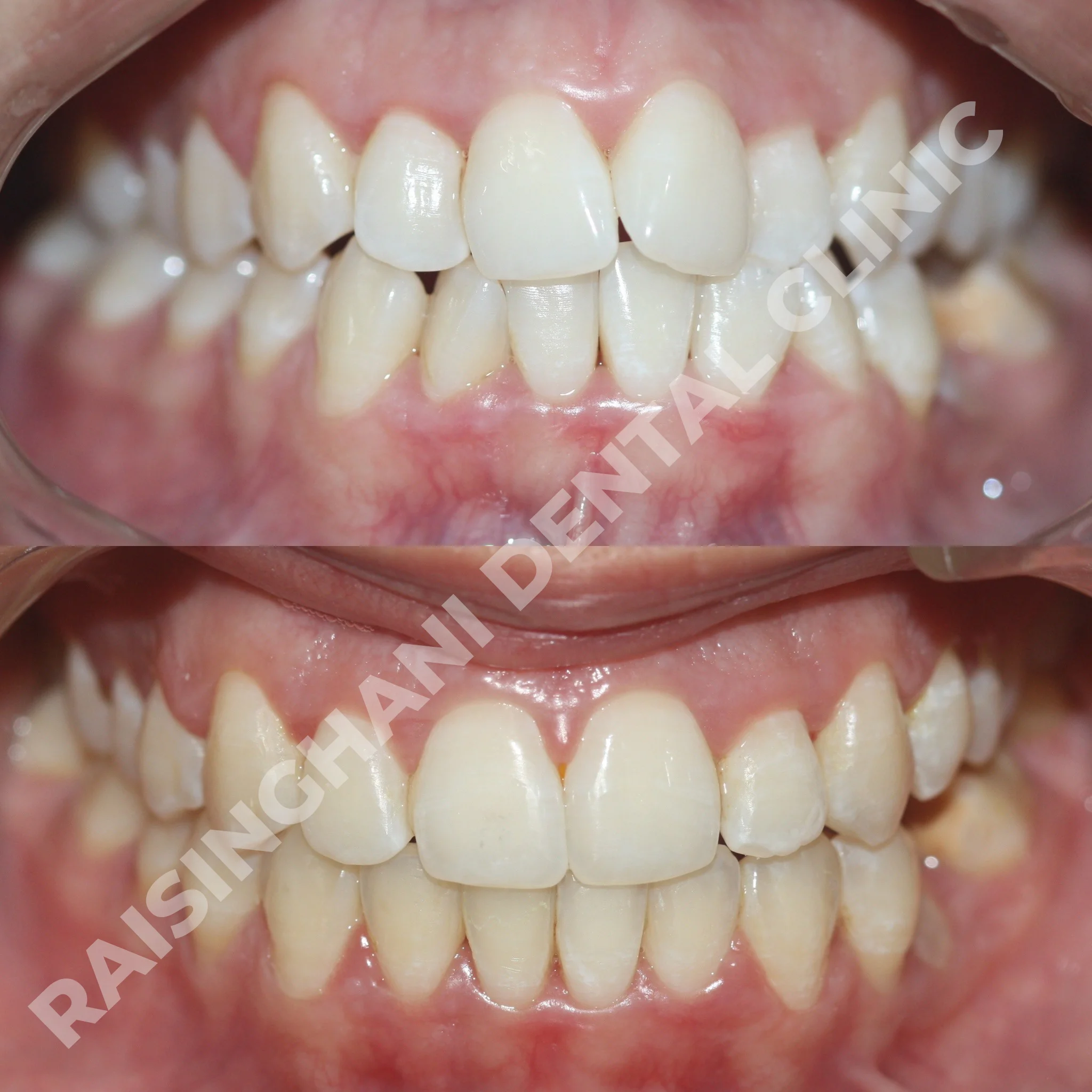 Braces & Aligners
