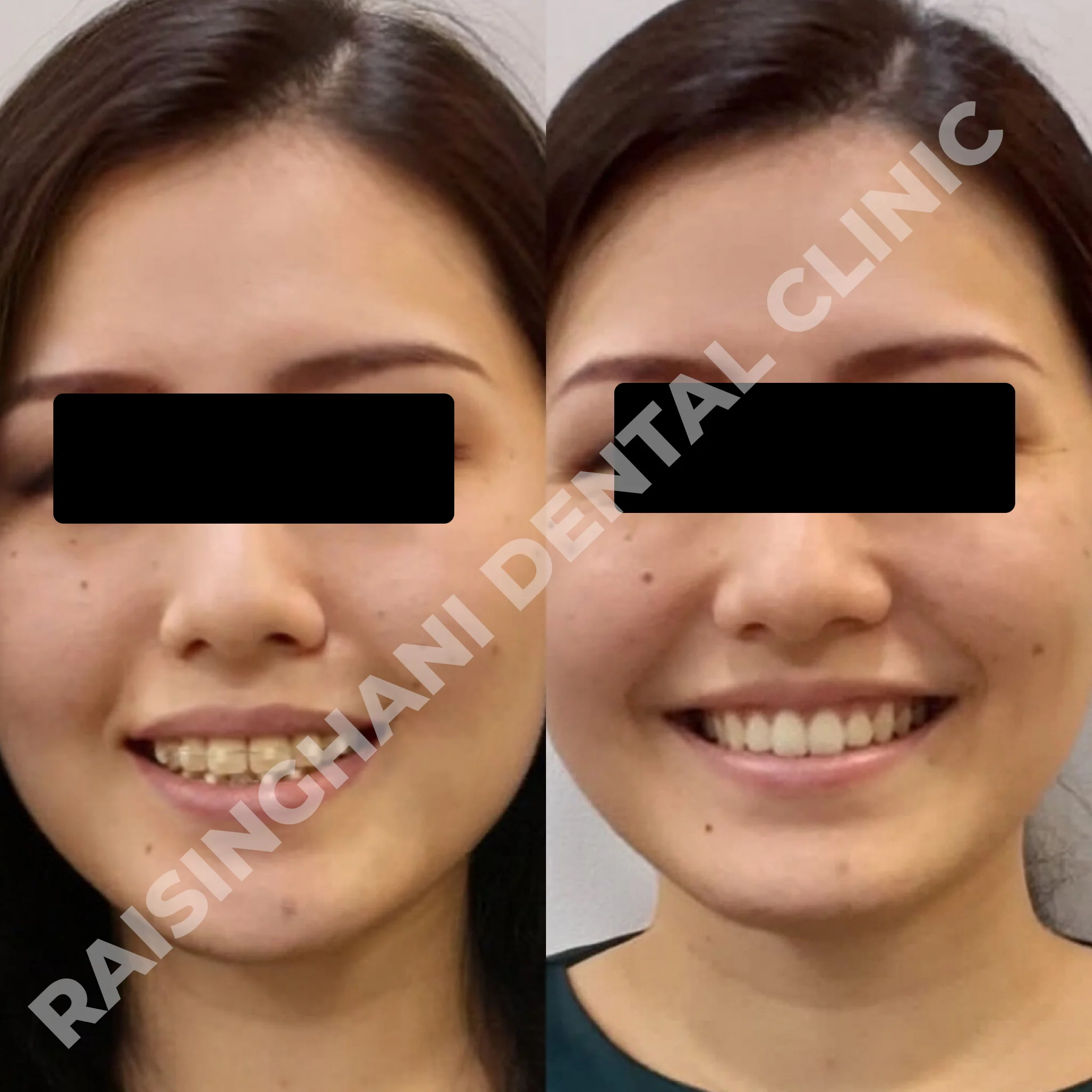 Braces & Aligners