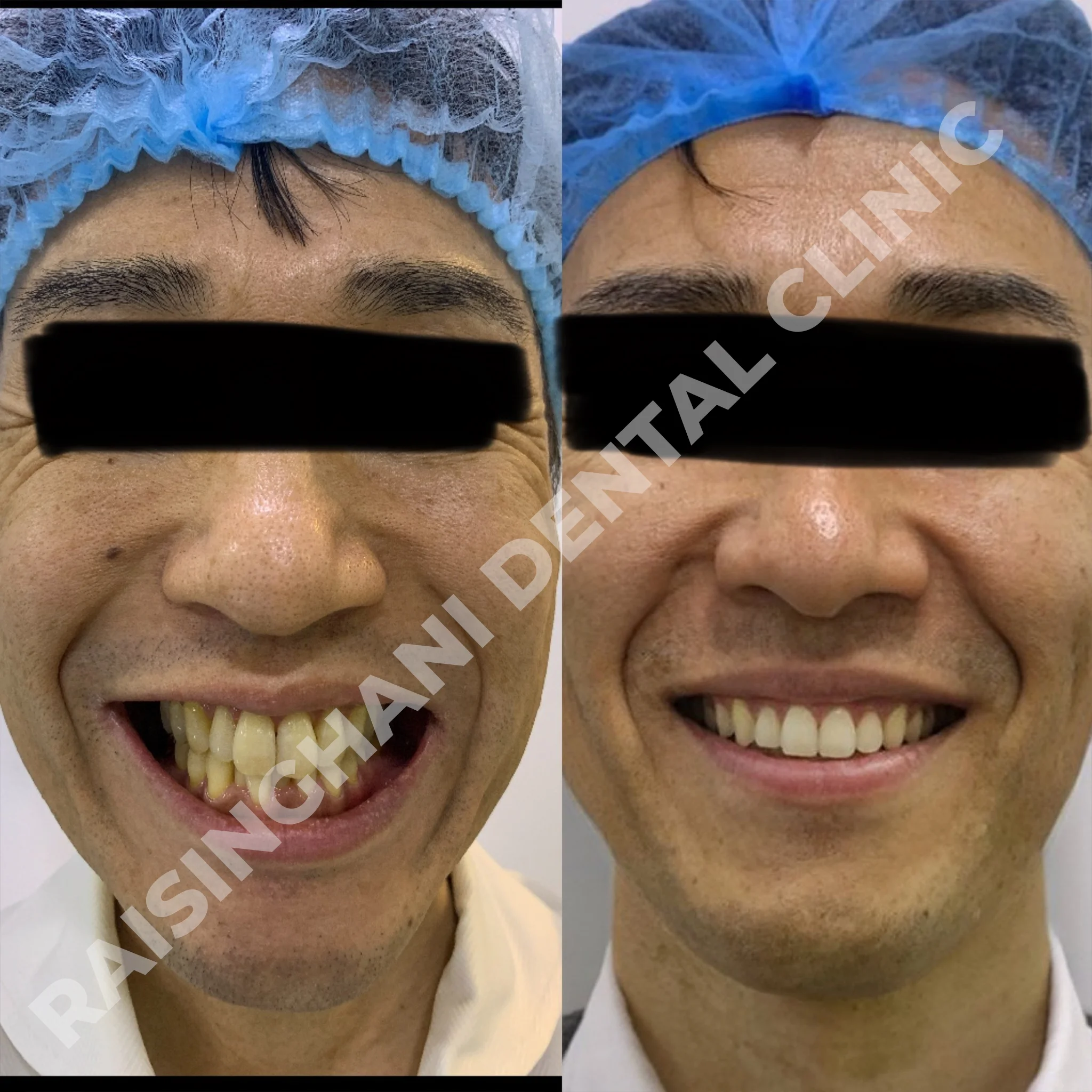 Braces & Aligners