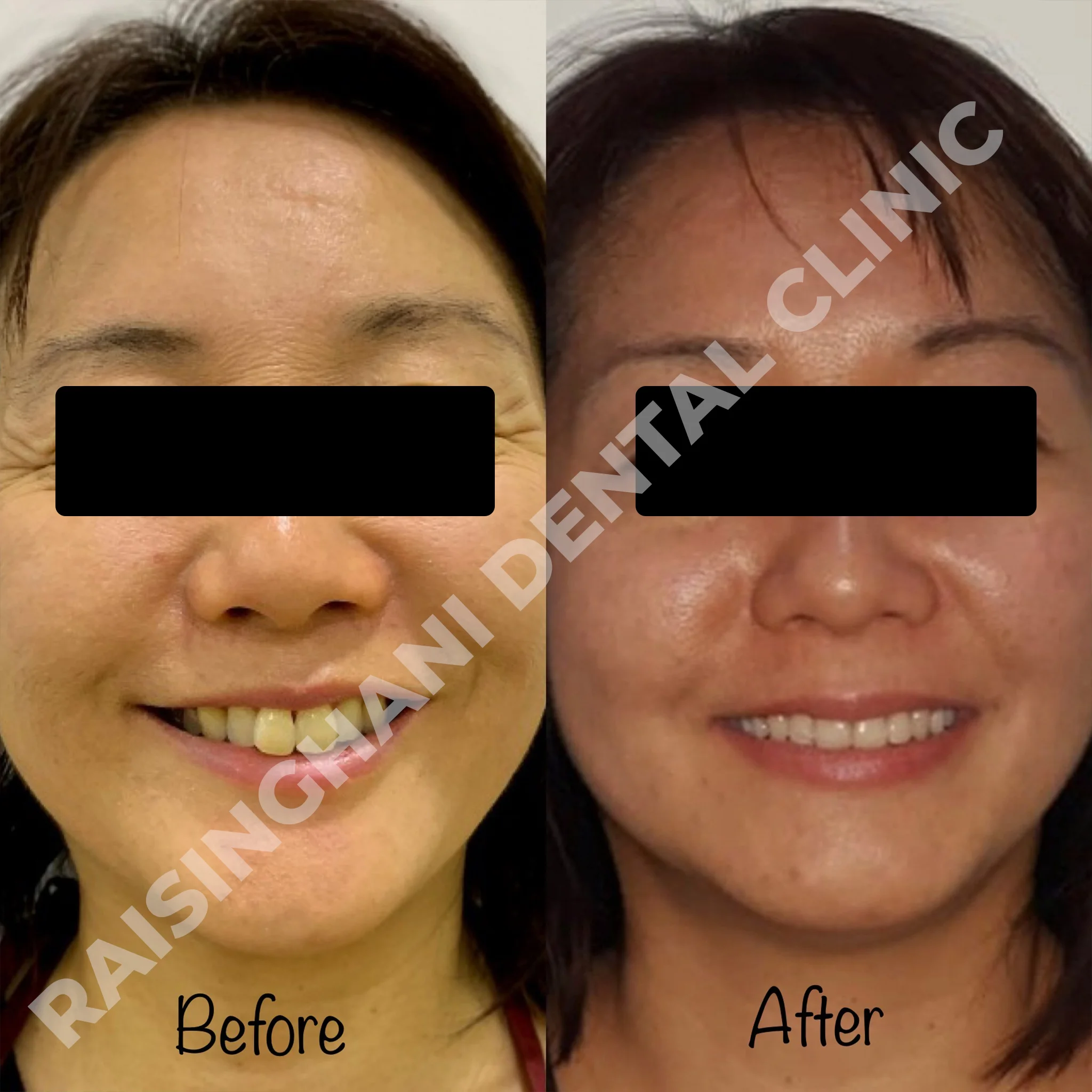Braces & Aligners