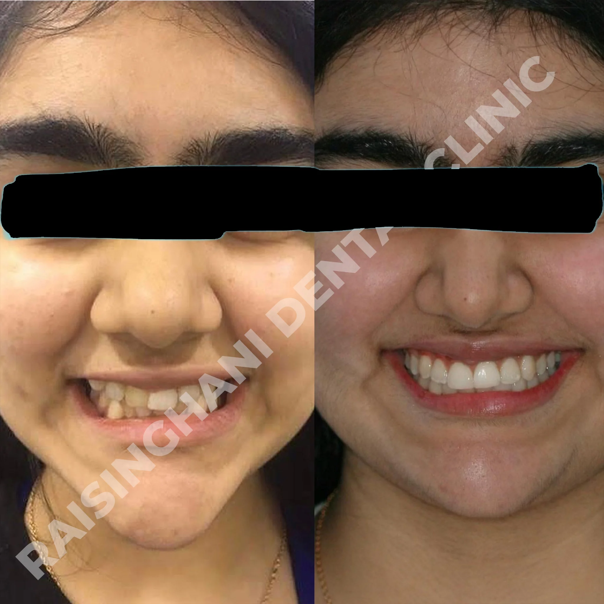 Braces & Aligners