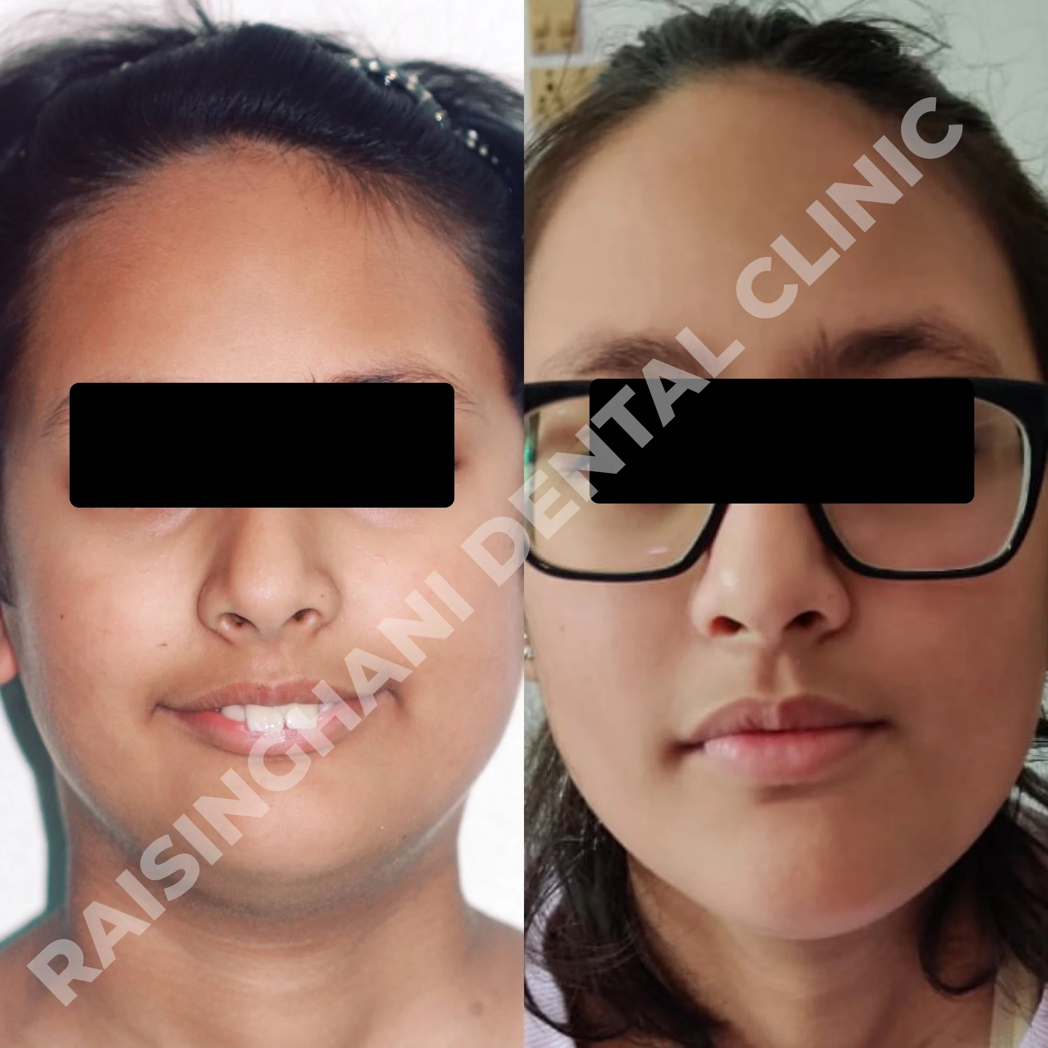 Braces & Aligners