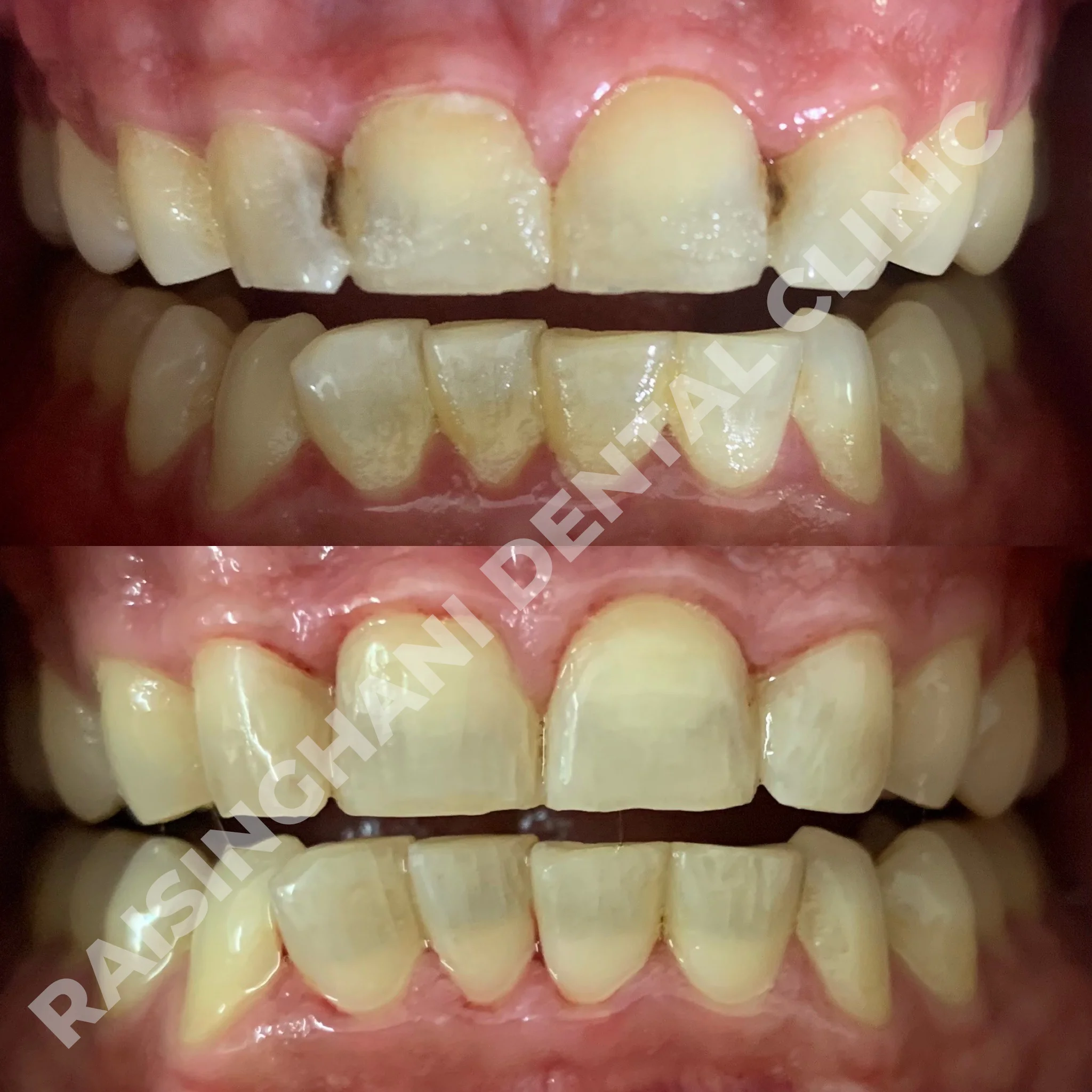 Cosmetic Fillings