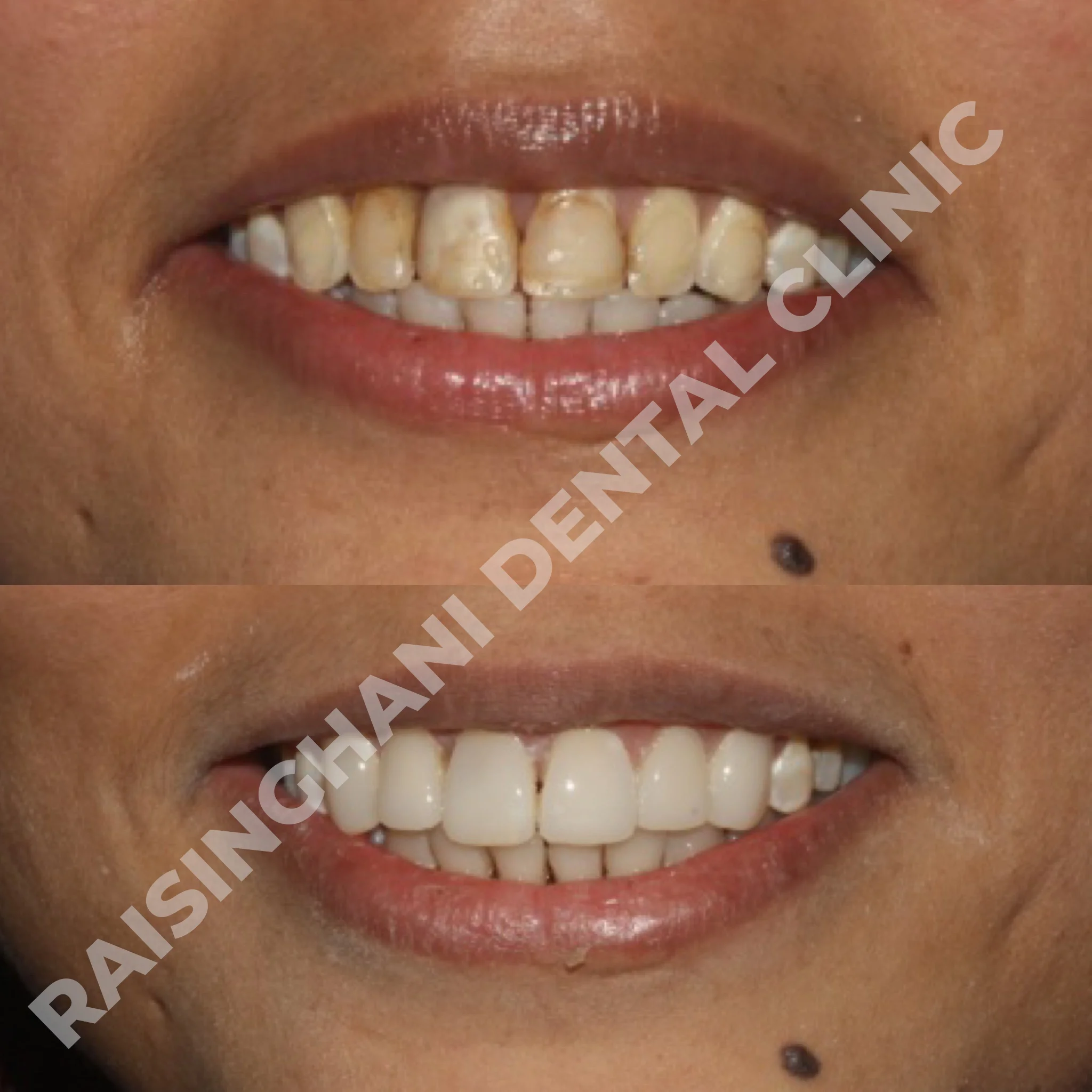 Cosmetic Fillings