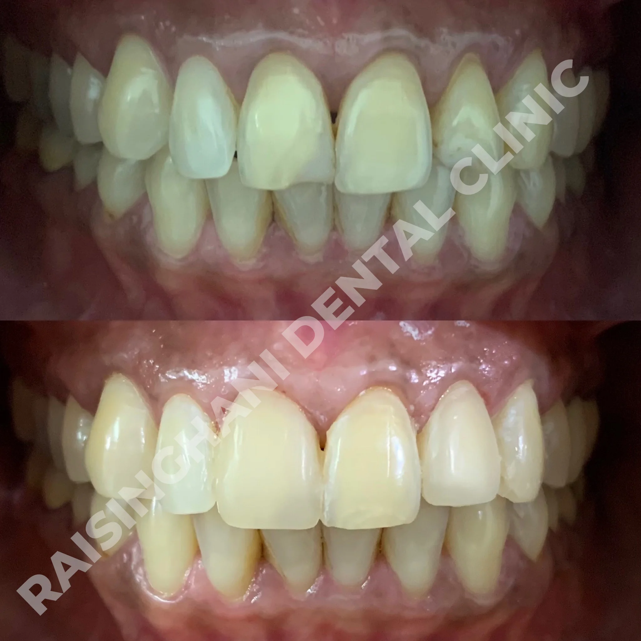 Cosmetic Fillings