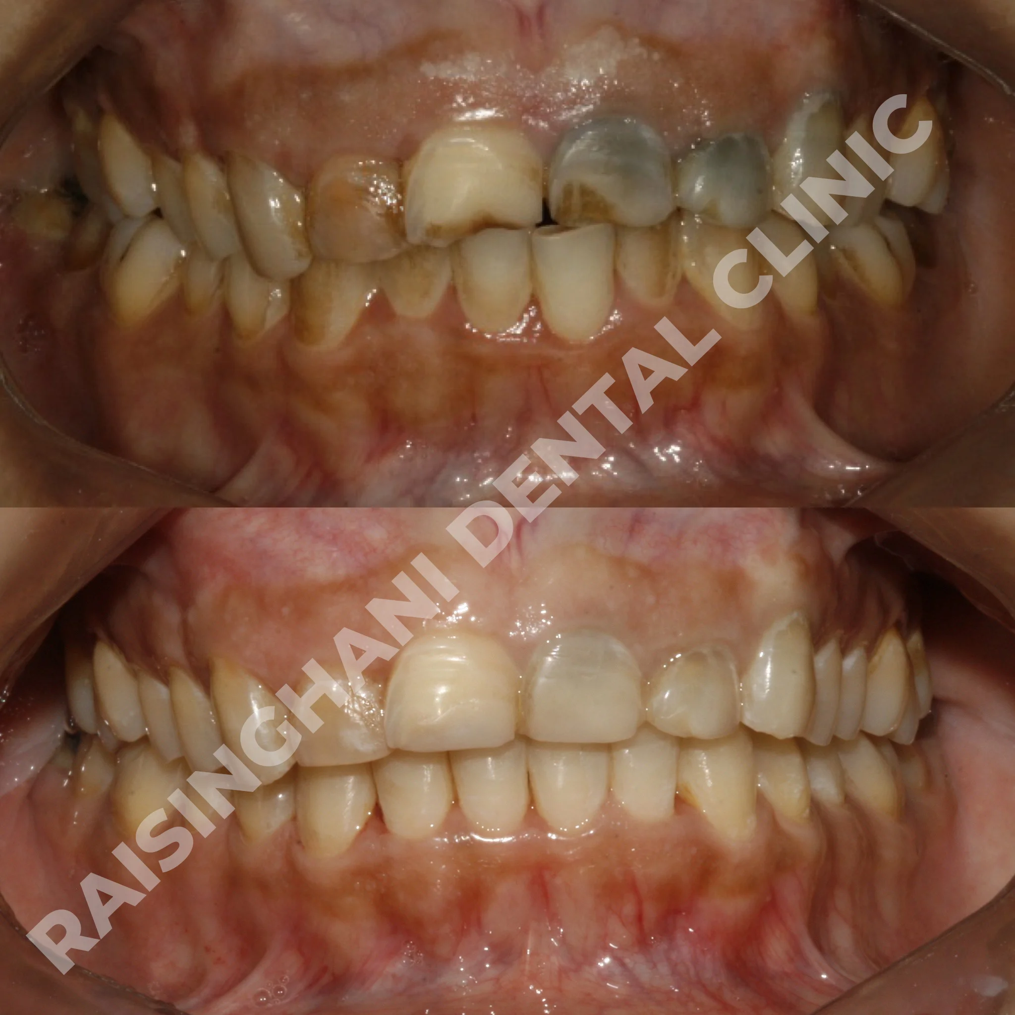 Cosmetic Fillings