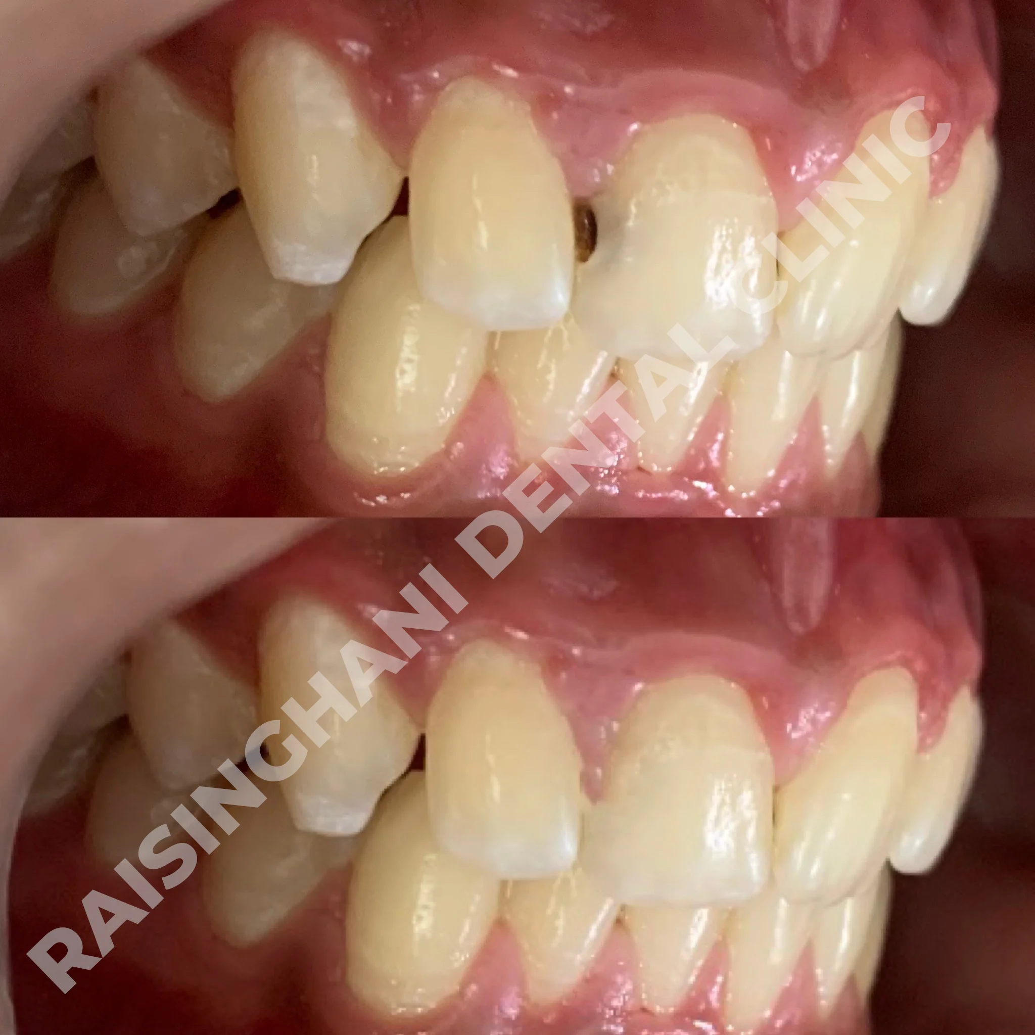 Cosmetic Fillings