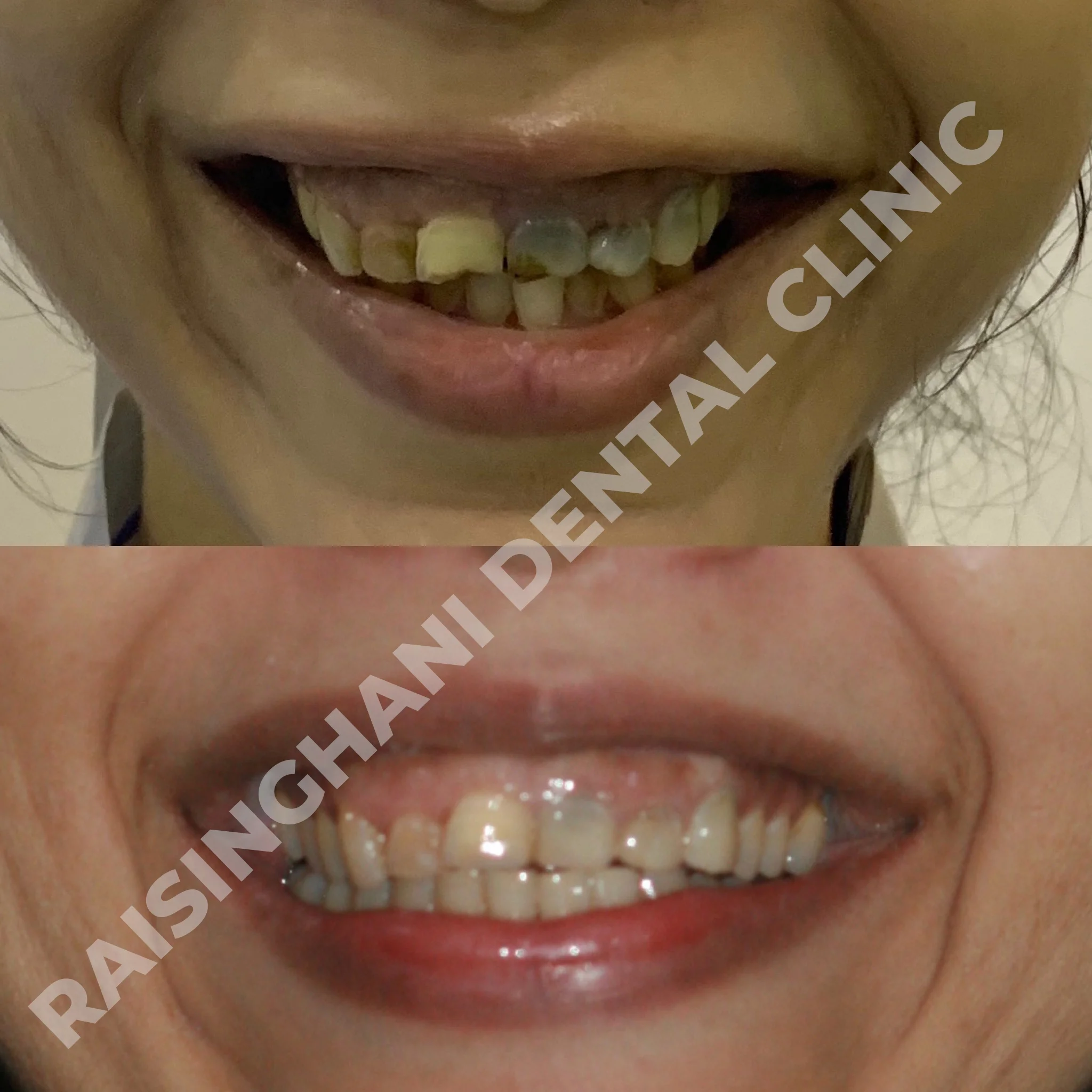 Cosmetic Fillings