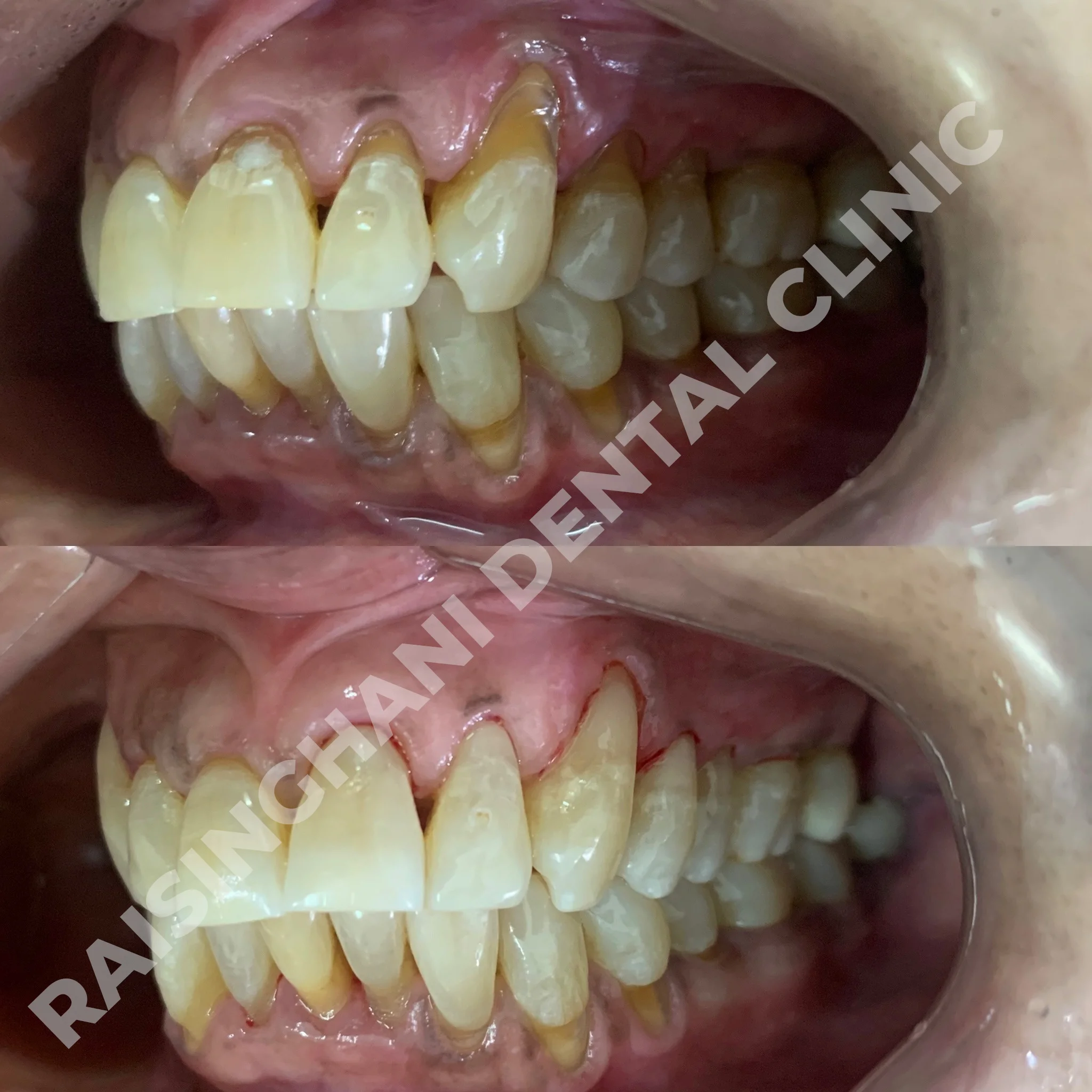 Cosmetic Fillings