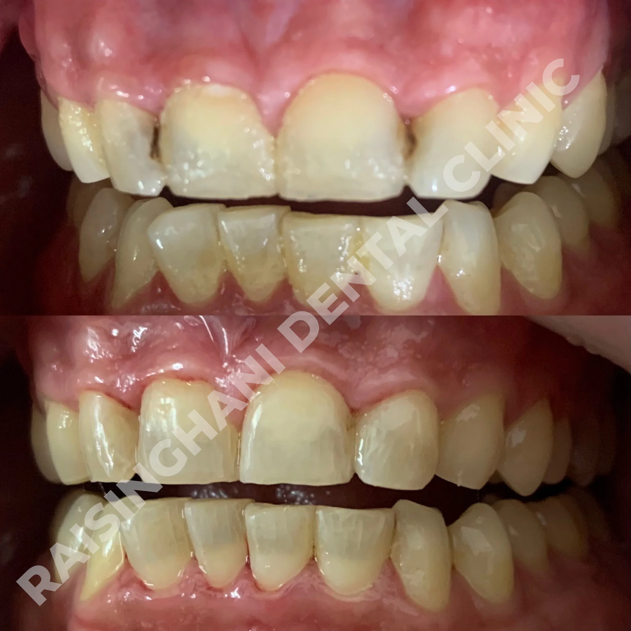 Cosmetic Fillings