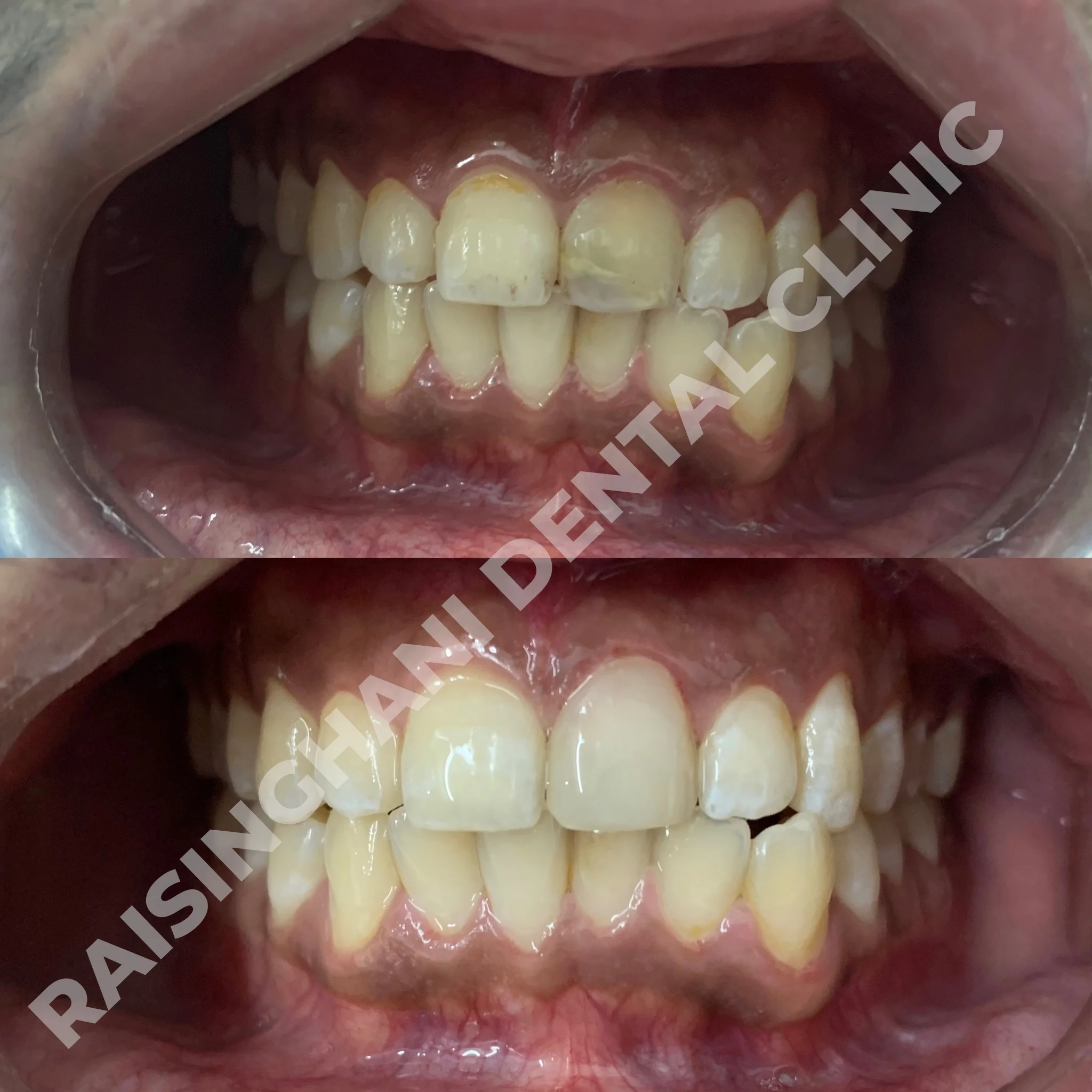 Cosmetic Fillings