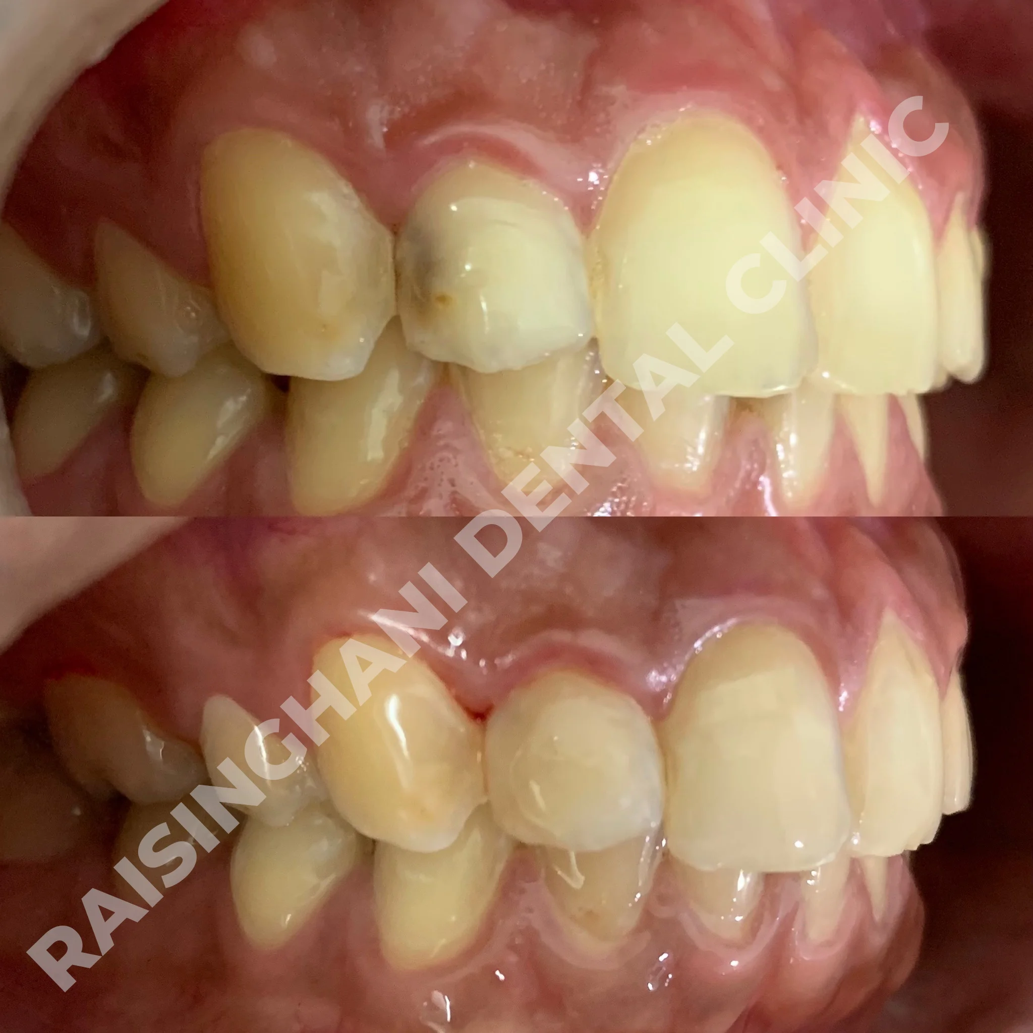 Cosmetic Fillings
