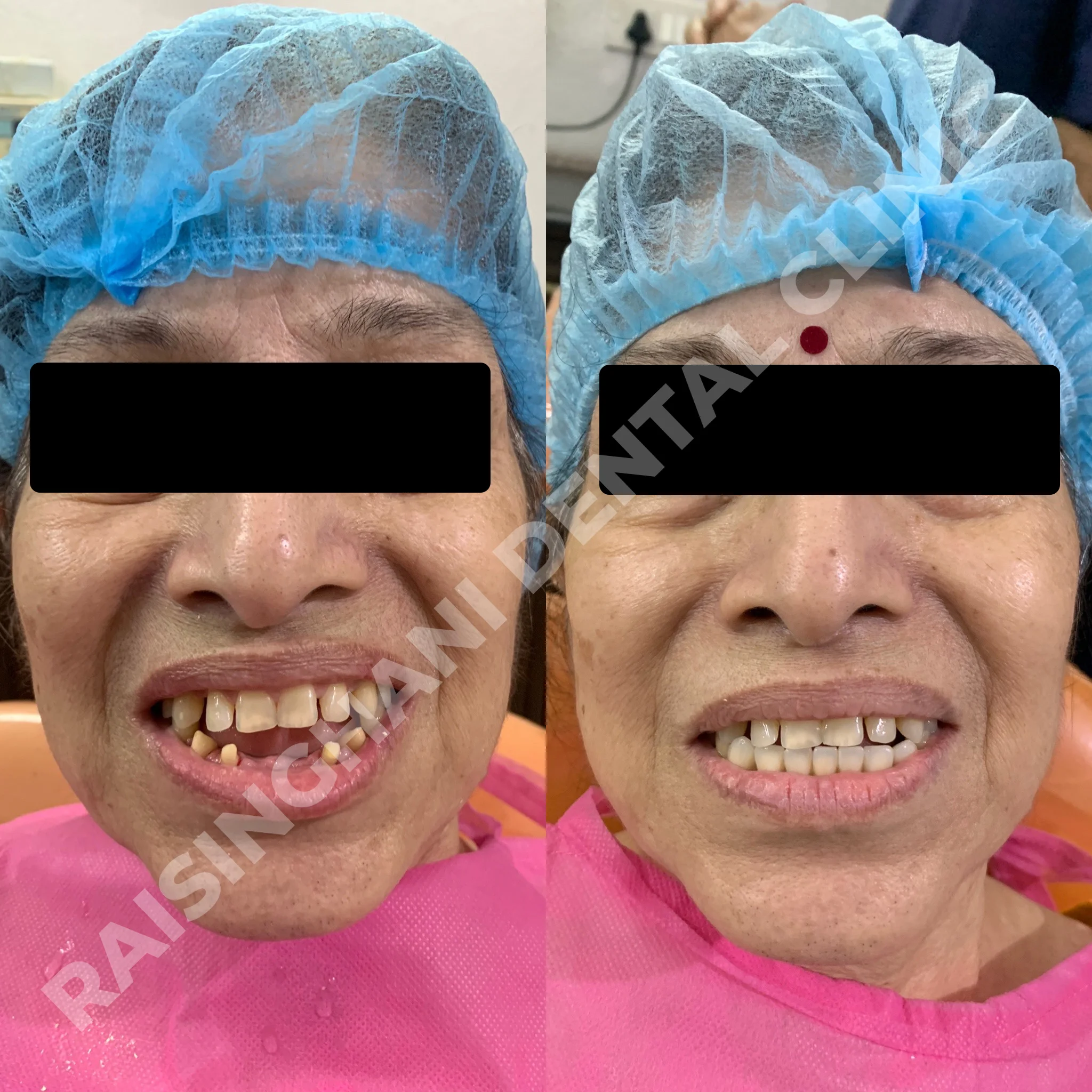 Dental Crown & Bridges