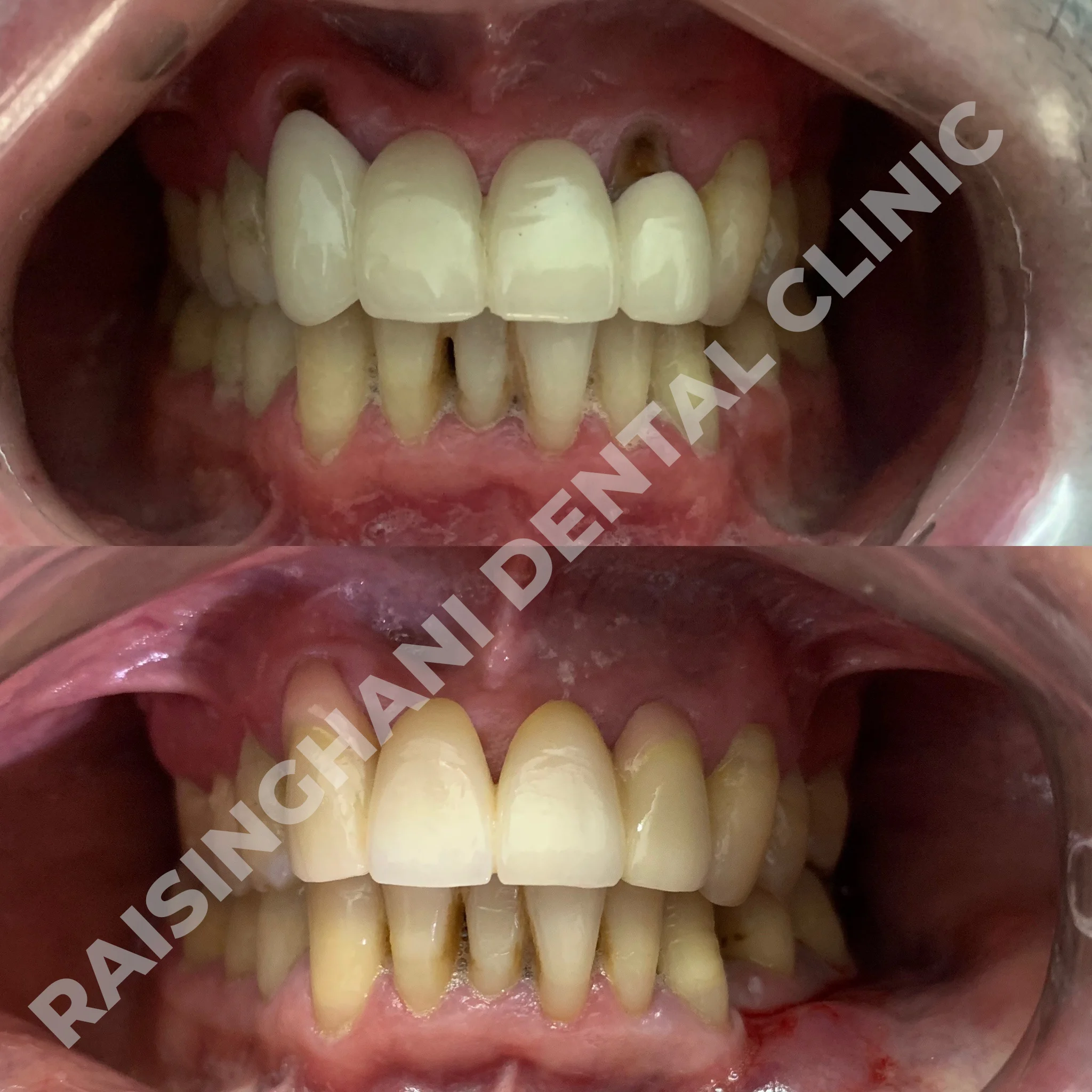Dental Crown & Bridges