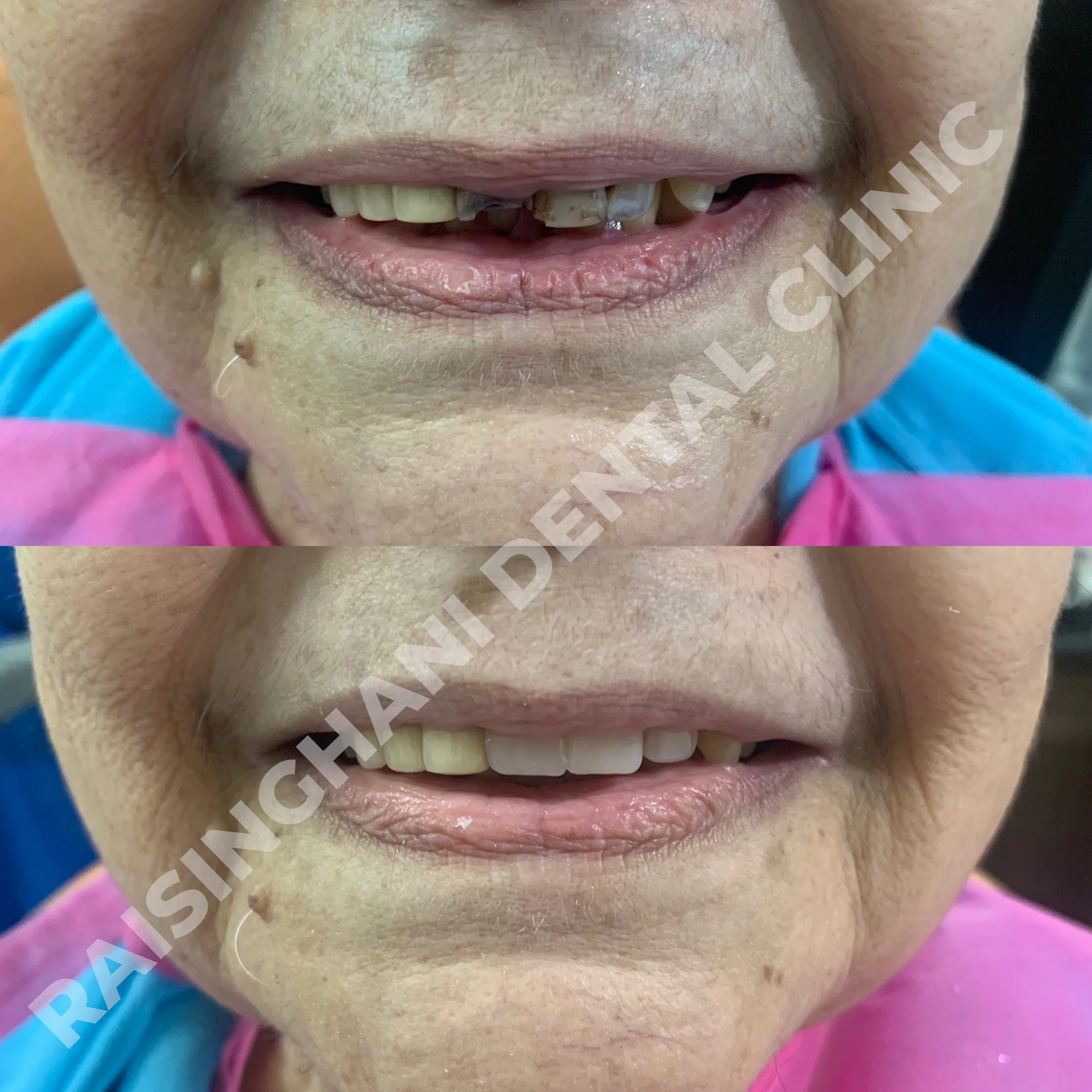 Dental Crown & Bridges