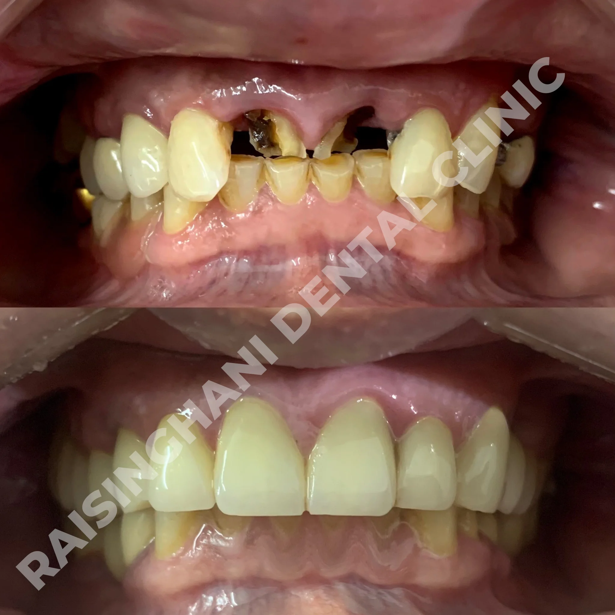 Dental Crown & Bridges