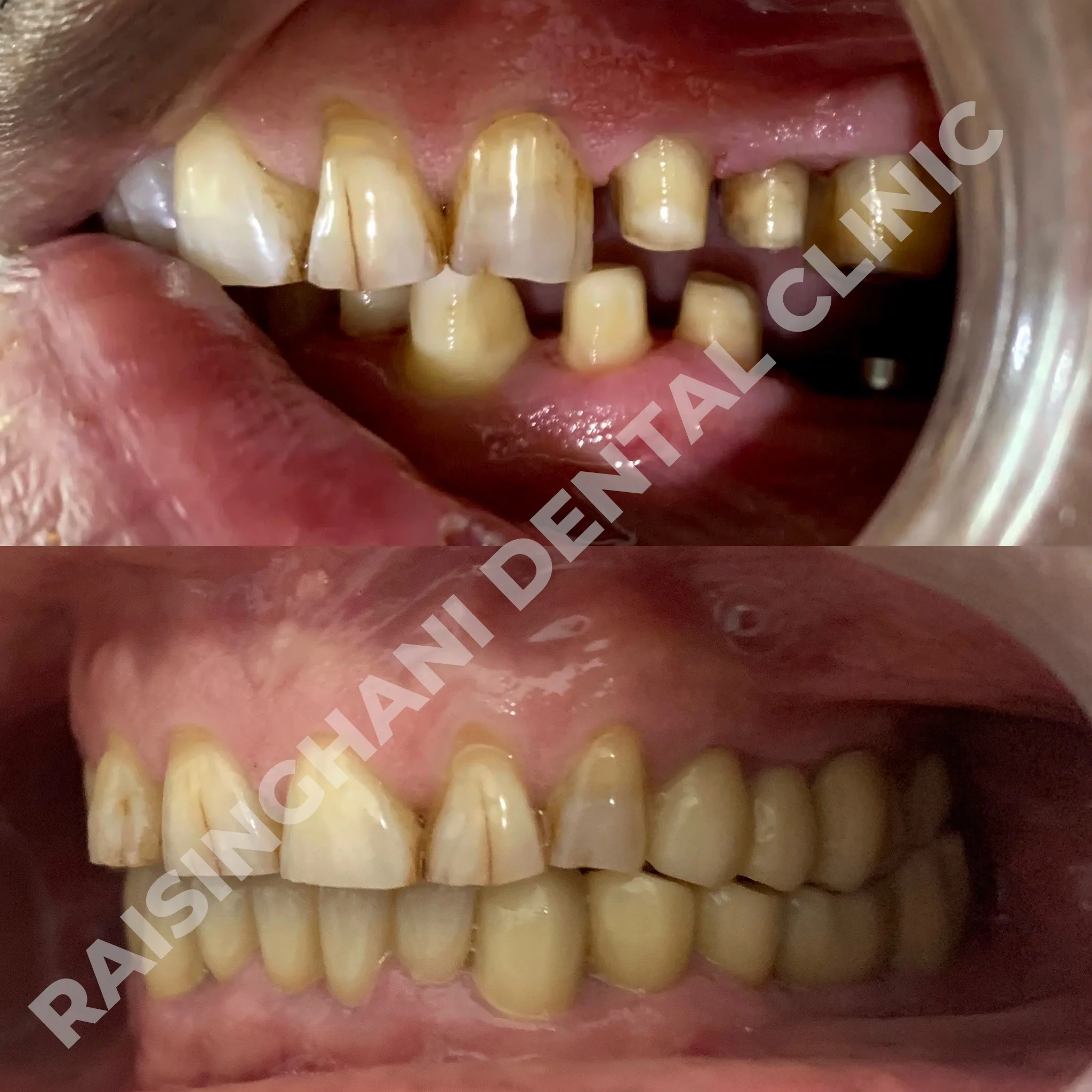 Dental Crown & Bridges