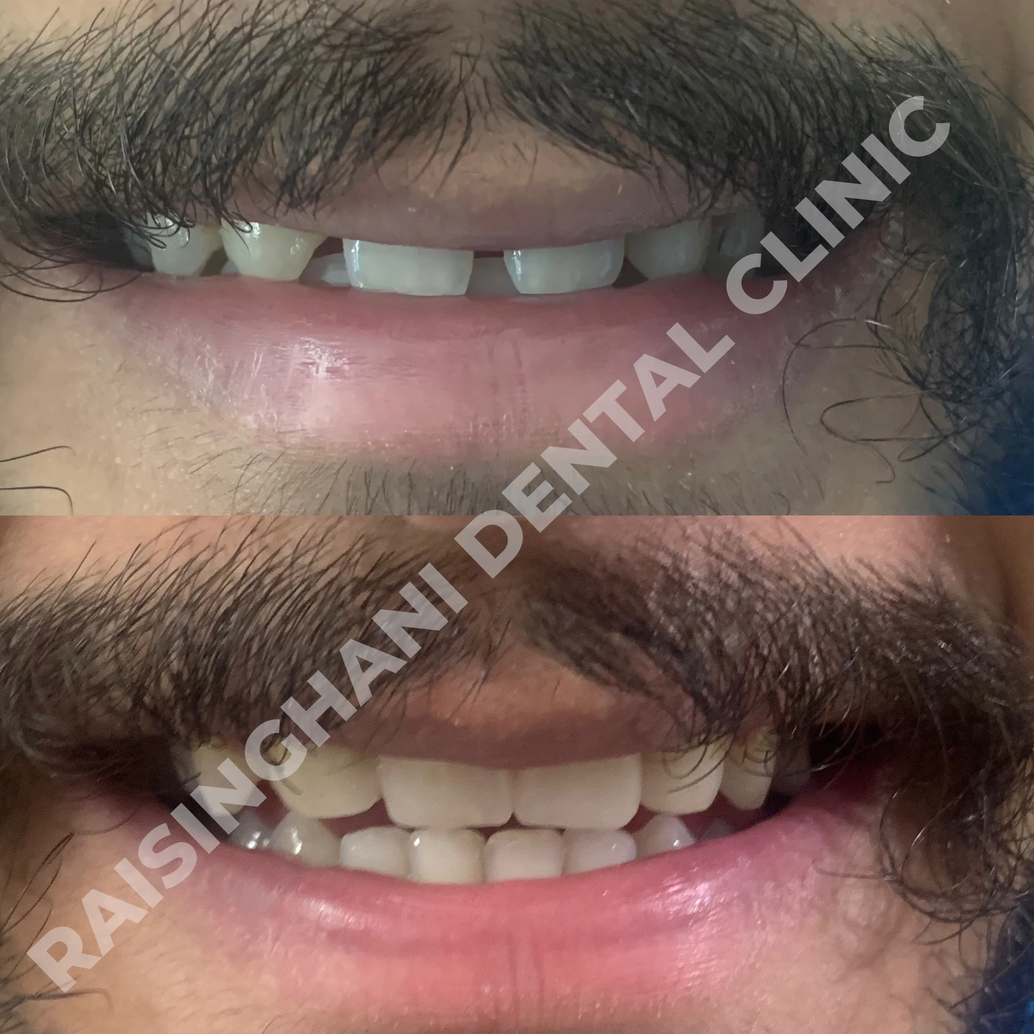 Dental Crown & Bridges
