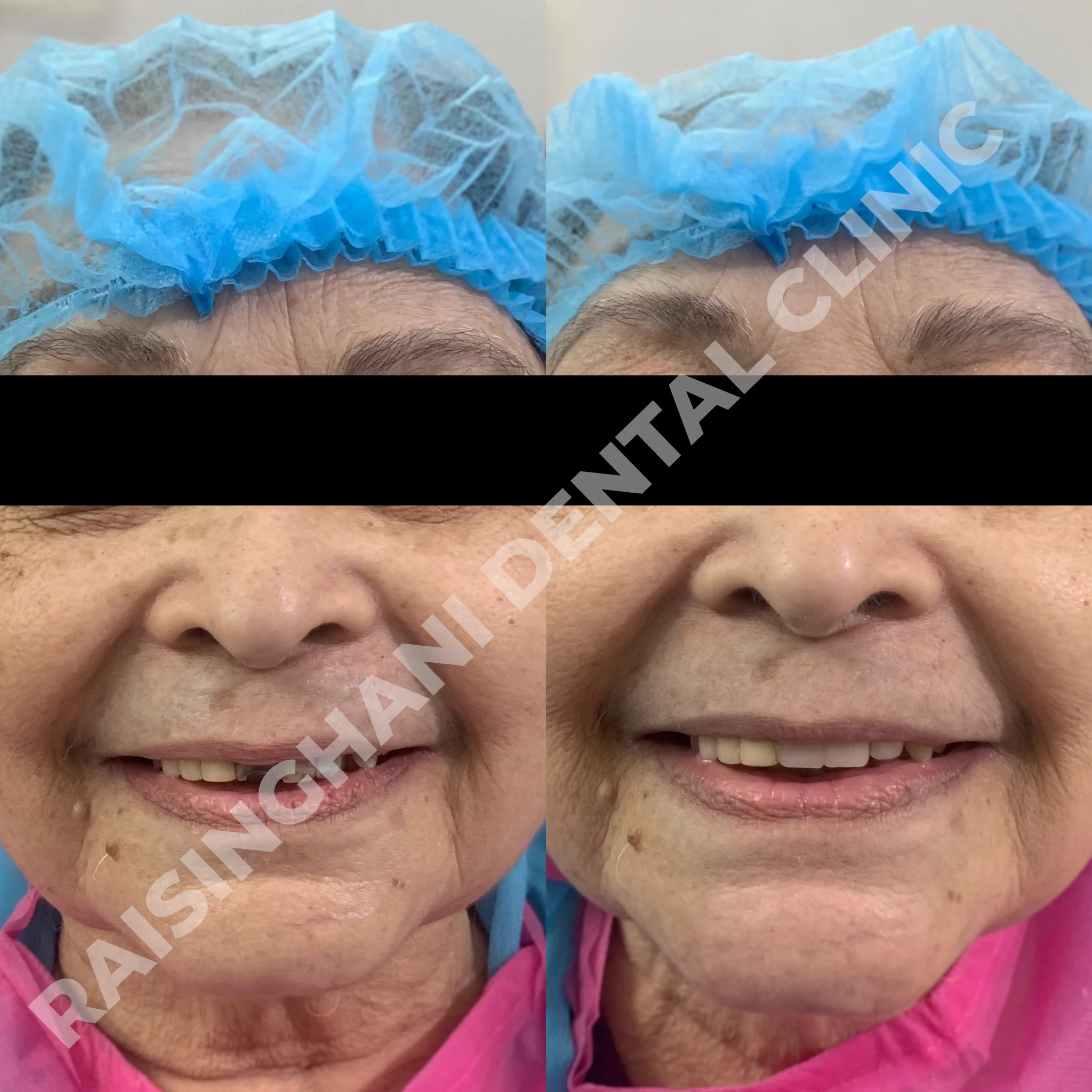 Dental Crown & Bridges
