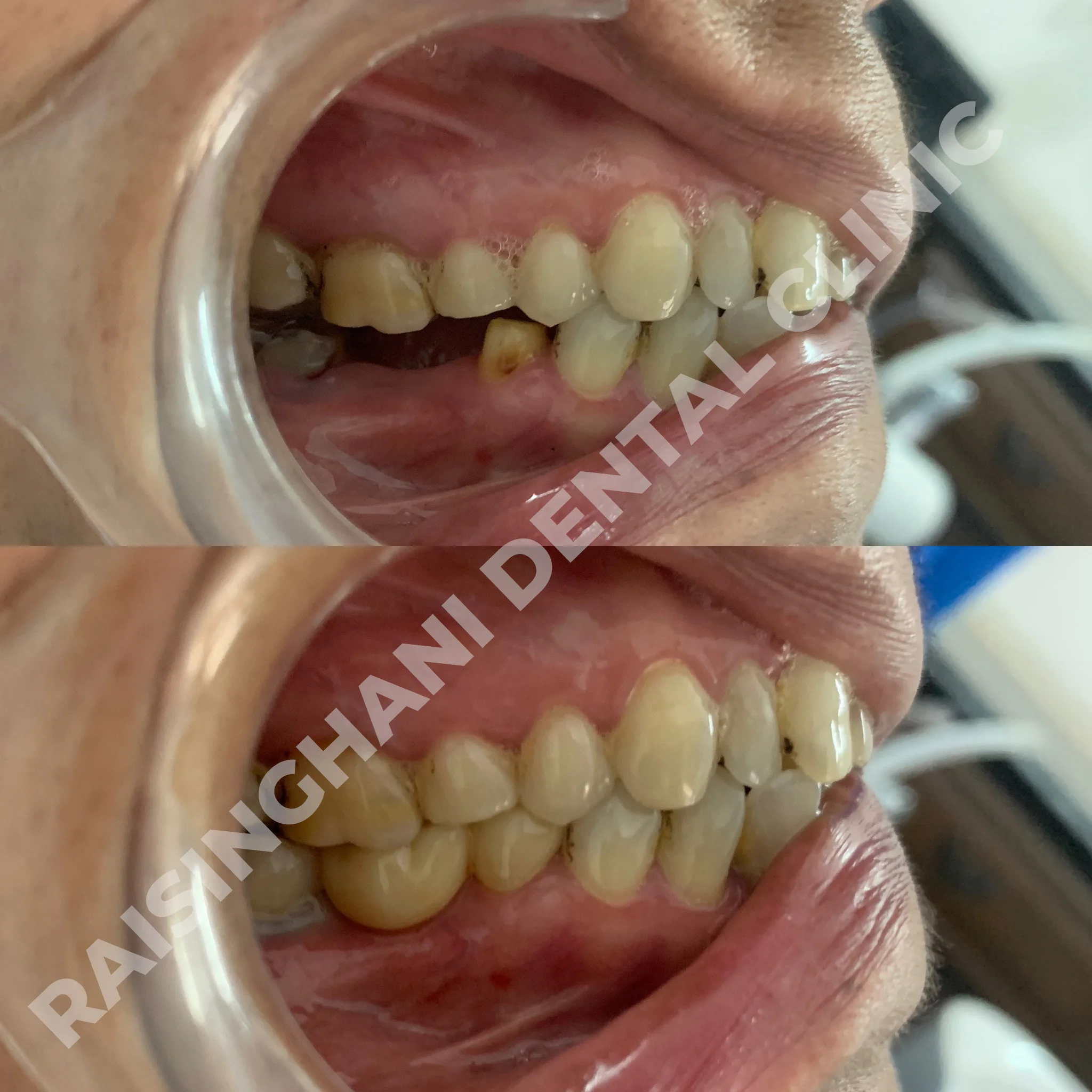 Dental Crown & Bridges