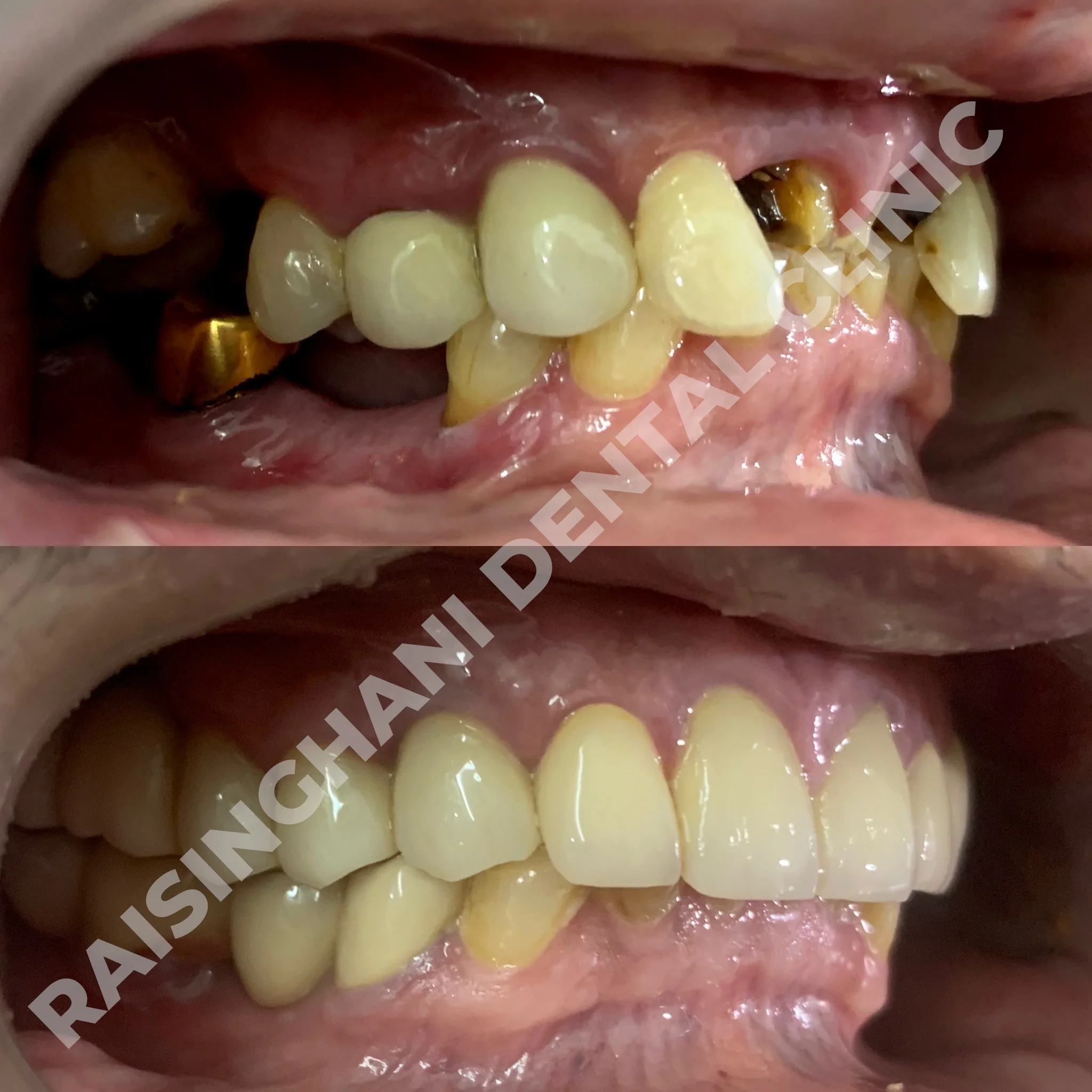 Dental Crown & Bridges
