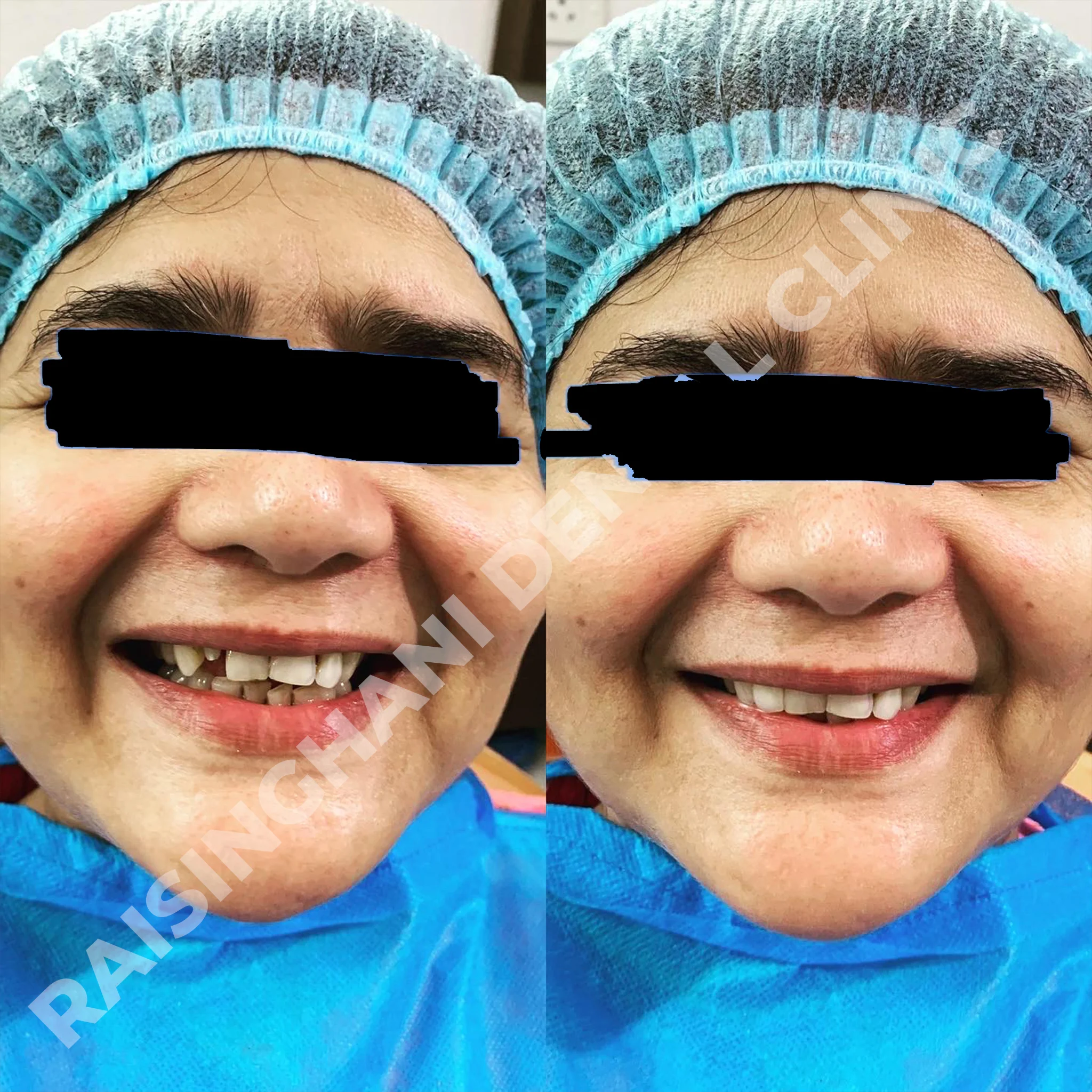 Dental Crown & Bridges