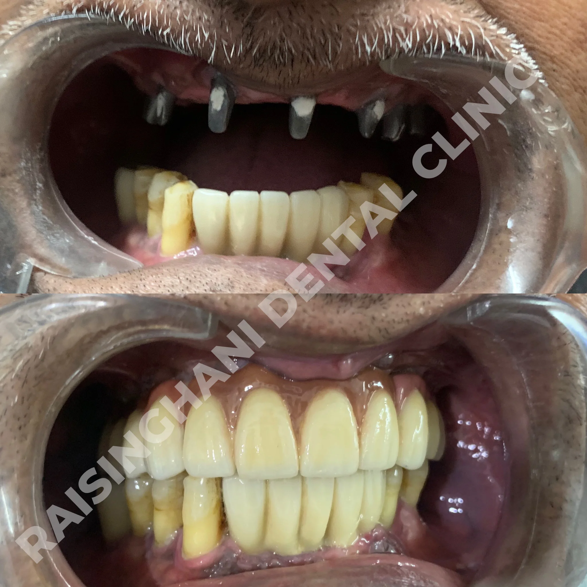 Dental Implants