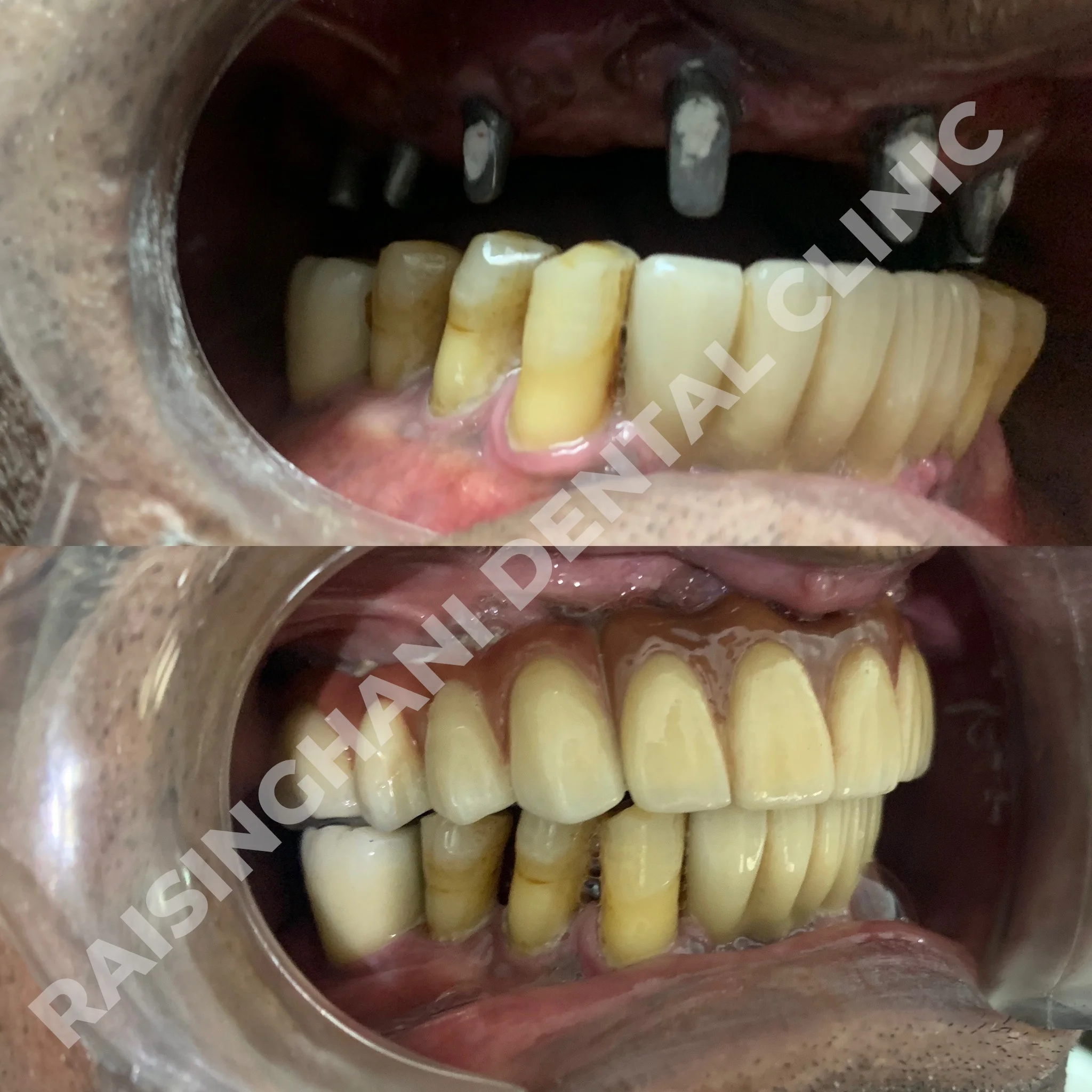 Dental Implants