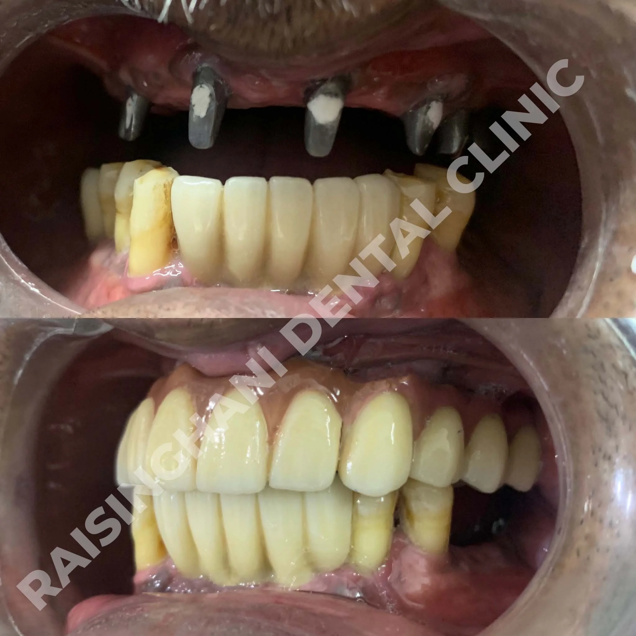Dental Implants