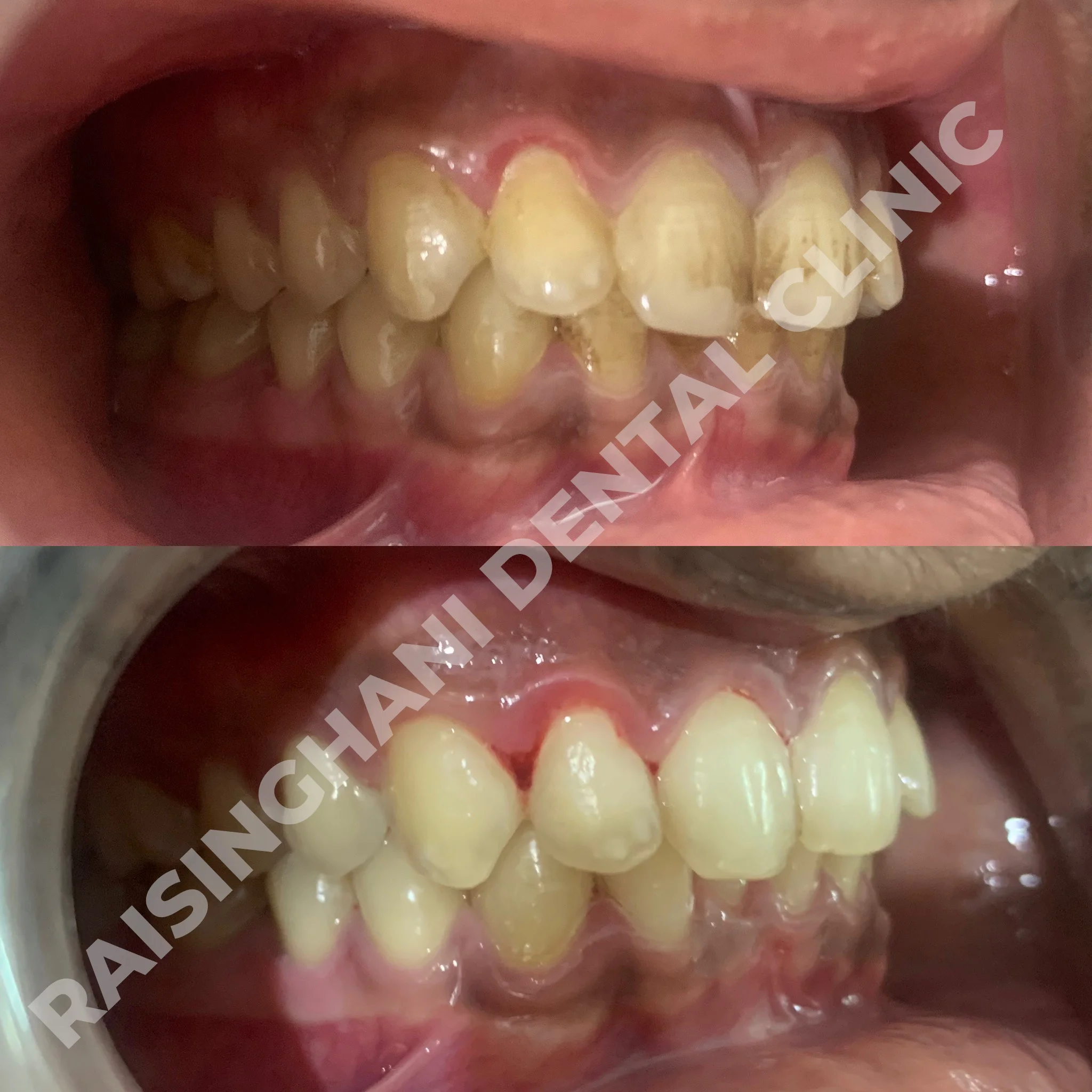 Teeth Cleaning & Whitening