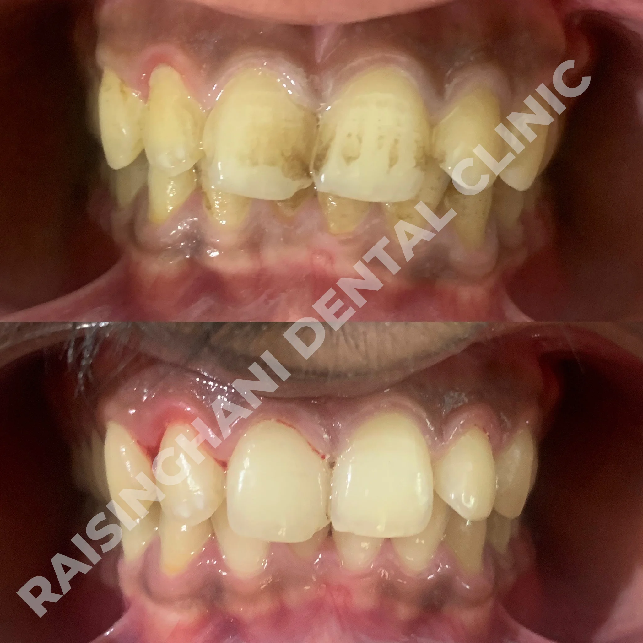 Teeth Cleaning & Whitening
